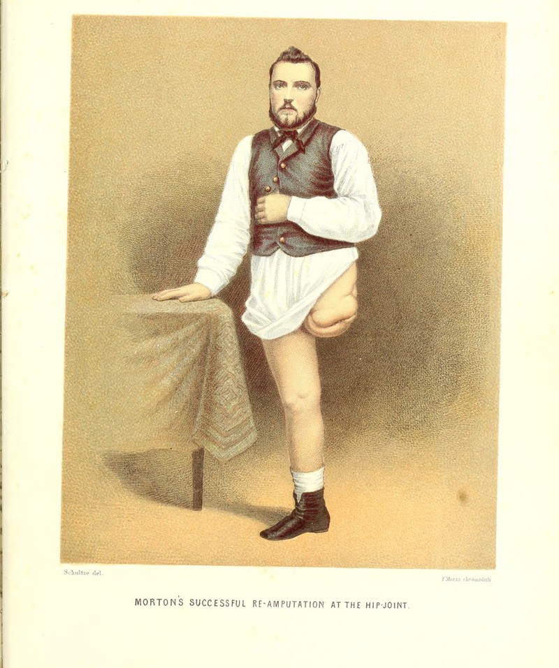 Sclniltze del. FMoras cbrouuAith MORTONS SUCCESSFUL RE-AMPUTATION AT THE HIP-JOlNT.