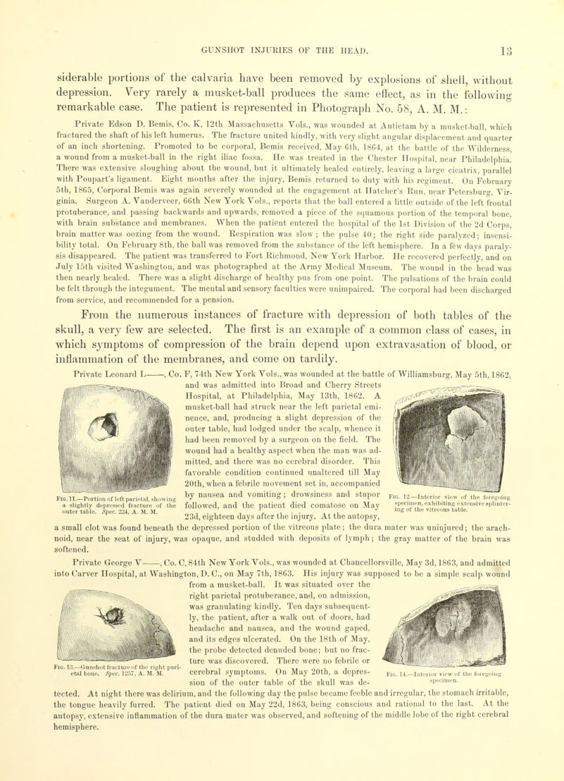 siderable portions of the calvaria have been removed by explosions of shell, without depression. Very rarely a musket-ball produces the same effect, as in the following remarkable case. The patient is represented in Photograph No. 58, A. M. M.: Private Edson D. Bemis, Co. K, 12th Massachusetts Vols., was wounded at Antietam by a musket-ball, which fractured the shaft of his left humerus. The fracture united kindly, with very slight angular displacement and quarter of an inch shortening. Promoted to be corporal, Bemis received, May 6th, 1864, at the battle of the Wilderness a wound from a musket-ball in the right iliac fossa. He was treated in the Chester Hospital, near Philadelphia. There was extensive sloughing about the wound, but it ultimately healed entirely, leaving a large cicatrix, parallel with Poupart's ligament. Eight months after the injury, Bemis returned to duty with his regiment. On February 5th, 1865, Corporal Bemis was again severely wounded at the engagement at Hatcher's Run, near Petersburg Vir- ginia. Surgeon A. Vanderveer, 66th New York Vols., reports that the ball entered a little outside of the left frontal protuberance, and passing backwards and upwards, removed a piece of the squamous portion of the temporal bone, with brain substance and membranes. When the patient entered the hospital of the 1st Division of the 2d Corps, brain matter was oozing from the wound. Respiration was slow; the pulse 40; the right side paralyzed; insensi- bility total. On February 8th, the ball was removed from the substance of the left hemisphere. In a few days paraly- sis disappeared. The patient was transferred to Fort Richmond, New York Harbor. He recovered perfectly, and on July 15th visited Washington, and was photographed at the Army Medical Museum. The wound in the head was then nearly healed. There was a slight discharge of healthy pus from one point. The pulsations of the brain could be felt through the integument. The mental and sensory faculties were unimpaired. The corporal had been discharged from service, and recommended for a pension. From the numerous instances of fracture with depression of both tables of the skull, a very few are selected. The first is an example of a common class of cases, in which symptoms of compression of the brain depend upon extravasation of blood, or inflammation of the membranes, and come on tardily. Private Leonard L -, Co. F, 74th New York Vols., was wounded at the battle of Williamsburg, May 5th, 1862, and was admitted into Broad and Cherry Streets Hospital, at Philadelphia, May 13th, 1862. A musket-ball had struck near the left parietal emi- nence, and, producing a slight depression of the outer table, had lodged under the scalp, whence it had been removed by a surgeon on the field. The wound had a healthy aspect when the man was ad- mitted, and there was no cerebral disorder. This favorable condition continued unaltered till May 20th, when a febrile movement set in, accompanied by nausea and vomiting; drowsiness and stupor followed, and the patient died comatose on May 23d, eighteen days after the injury. At the autopsy, a small clot was found beneath the depressed portion of the vitreous plate; the dura mater was uninjured; the arach- noid, near the seat of injury, was opaque, and studded with deposits of lymph; the gray matter of the brain was softened. Private George Y , Co. C, 84th New York Vols., was wounded at Chancellorsville, May 3d, 1863, and admitted into Carver Hospital, at Washington, D. C, on May 7th, 1863. His injury was supposed to be a simple scalp wound from a musket-ball. It was situated over the right parietal protuberance, and, on admission, was granulating kindly. Ten days subsequent- ly, the patient, after a walk out of doors, had headache and nausea, and the wound gaped, and its edges ulcerated. On the 18th of May, the probe detected denuded bone; but no frac- ture was discovered. There were no febrile or cerebral symptoms. On May 20th, a depres- sion of the outer table of the skull was de- tected. At night there was delirium, and the following day the pulse became feeble and irregular, the stomach irritable, the tongue heavily furred. The patient died on May 22d, 1863, being conscious and rational to the last. At the autopsy, extensive inflammation of the dura mater was observed, and softening of the middle lobe of the right cerebral hemisphere. Fio. 11.—Portion of left parietal, showing a slightly depressed fracture of the outer table. Spec. 224, A. M. M. Pig. 12.—Interior view of the foregoing specimen, exhibiting extensive splinter- ing of the vitreous table. FlG.l 3.—Gunshot fracture of the right pari- etal bone. S2KC. 1257, A. M. M. Fig. 14.—Interior view of the foieg< specimen.