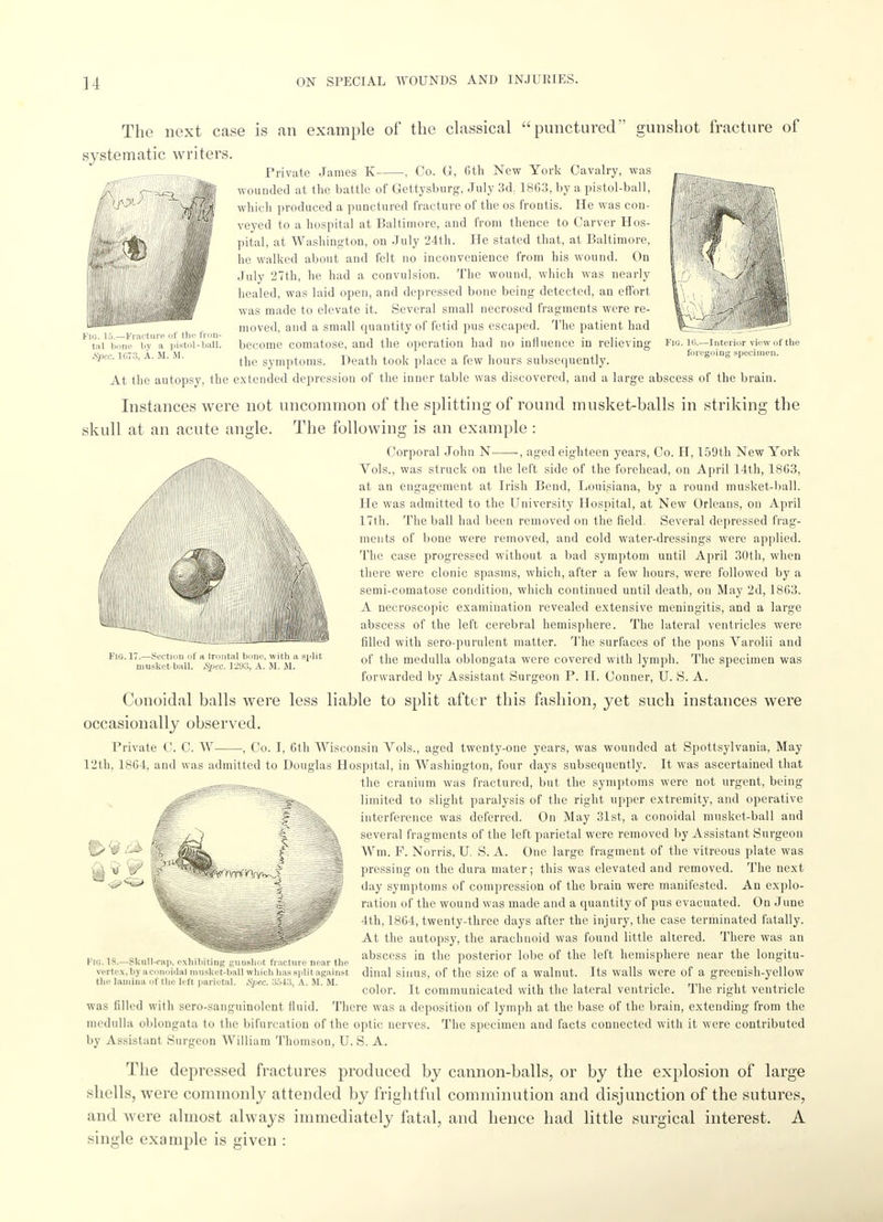 The next case is an example of the classical punctured gunshot fracture of systematic writers. •'-X A Fig. 15.—fracture of the fron- tal bone by a pistol-ball Spec. 1(573, A. M. M. . l'i.—Interior view of the foregoing specimen. :yHl Private James K , Co. G, 6th New York Cavalry, was wounded at the battle of Gettysburg, July 3d. 1863, by a pistol-ball, which produced a punctured fracture of the os frontis. He was con- veyed to a hospital at Baltimore, and from thence to Carver Hos- pital, at Washington, on July 24th. He stated that, at Baltimore, he walked about and felt no inconvenience from his wound. On July 27th, he had a convulsion. The wound, which was nearly healed, was laid open, and depressed bone being detected, an effort was made to elevate it. Several small necrosed fragments were re- moved, and a small quantity of fetid pus escaped. The patient had become comatose, and the operation had no influence in relieving the symptoms. Death took place a few hours subsequently. At the autopsy, the extended depression of the inner table was discovered, and a large abscess of the brain. Instances were not uncommon of the splitting of round musket-balls in striking the skull at an acute angle. The following is an example: Corporal John N -, aged eighteen years, Co. H, 159th New York Vols., was struck on the left side of the forehead, on April 14th, 1863, at an engagement at Irish Bend, Louisiana, by a round musket-ball. He was admitted to the University Hospital, at New Orleans, on April 17th. The ball had been removed on the field. Several depressed frag- ments of bone were removed, and cold water-dressings were applied. The case progressed without a bad symptom until April 30th, when there were clonic spasms, which, after a few hours, were followed by a semi-comatose condition, which continued until death, on May 2d, 1863. A necroscopic examination revealed extensive meningitis, and a large abscess of the left cerebral hemisphere. The lateral ventricles were filled with sero-purulent matter. The surfaces of the pons Varolii and of the medulla oblongata were covered with lymph. The specimen was forwarded by Assistant Surgeon P. H. Conner, U. S. A. Conoidal balls were less liable to split after this fashion, yet such instances were occasionally observed. Private C. C. W , Co. I, 6th Wisconsin Vols., aged twenty-one years, was wounded at Spottsylvania, May 12th, 1864, and was admitted to Douglas Hospital, in Washington, four days subsequently. It was ascertained that the cranium was fractured, but the symptoms were not urgent, being limited to slight paralysis of the right upper extremity, and operative interference was deferred. On May 31st, a conoidal musket-ball and several fragments of the left parietal were removed by Assistant Surgeon Wm. F. Norris, U. S. A. One large fragment of the vitreous plate was pressing on the dura mater; this was elevated and removed. The next day symptoms of compression of the brain were manifested. An explo- ration of the wound was made and a quantity of pus evacuated. On June 4th, 1864, twenty-three days after the injury, the case terminated fatally. At the autopsy, the arachnoid was found little altered. There was an abscess in the posterior lobe of the left hemisphere near the longitu- dinal sinus, of the size of a walnut. Its walls were of a greenish-yellow color. It communicated with the lateral ventricle. The right ventricle was filled with sero-sanguinolent fluid. There was a deposition of lymph at the base of the brain, extending from the medulla oblongata to the bifurcation of the optic nerves. The specimen and facts connected with it were contributed by Assistant Surgeon William Thomson, U. S. A. The depressed fractures produced by cannon-balls, or by the explosion of large shells, were commonly attended by frightful comminution and disjunction of the sutures, and were almost always immediately fatal, and hence had little surgical interest. A single example is given : .7.—Section of ti Irontal bone, with a split musket ball. Sjiec. 1293, A. M. II. FlO. IS.—Skull-rap. exhibiting gu vertex, by aconoidal musket-bal the lauiiua of the left parietal. ishot fracture near the which has split against Spec. 3543, A. M. M.