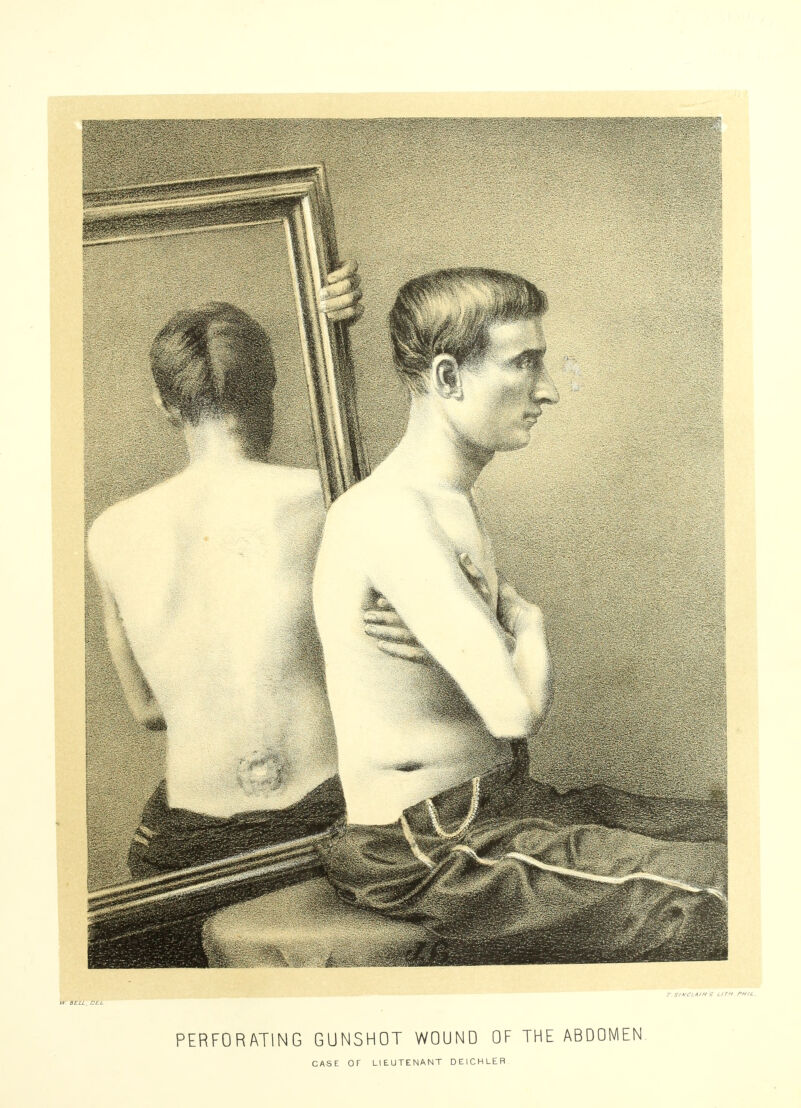 PERFORATING GUNSHOT WOUND OF THE ABDOMEN CASE Or LIEUTENANT DElCHLER