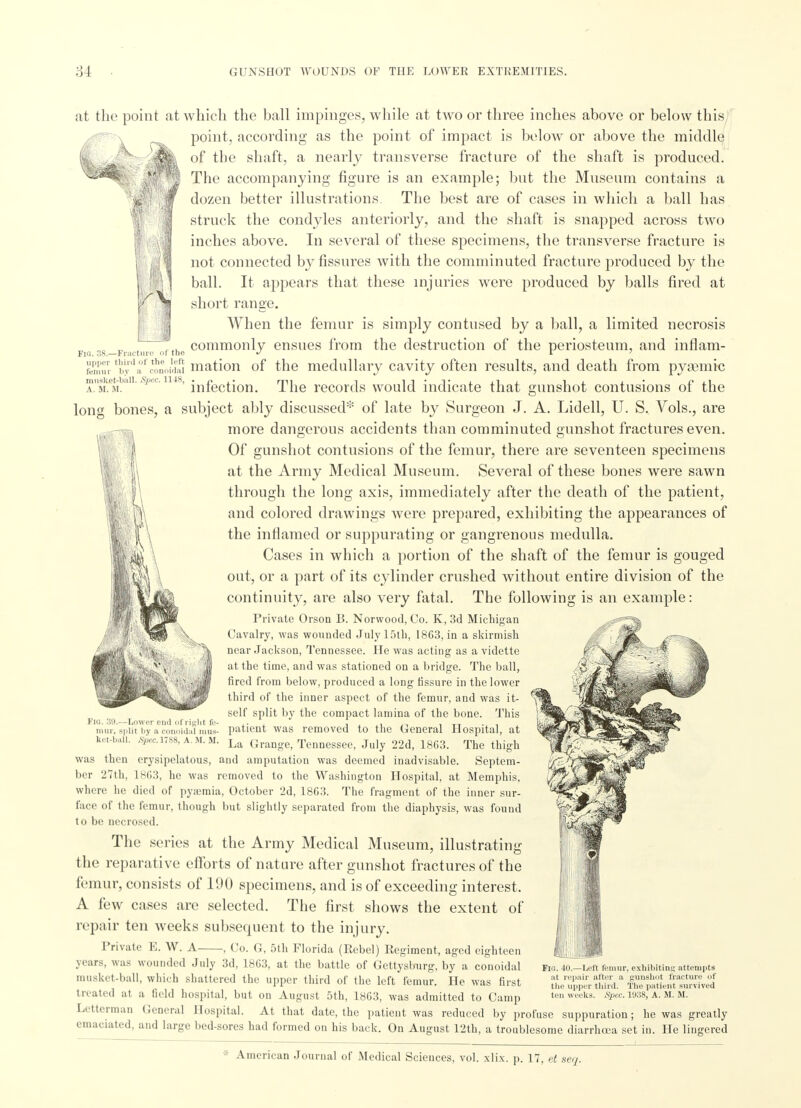 Fio. 38.—Fracture of the musket-ball. Spec. 1118, A. M. M. long bones, at the point at which the ball impinges, while at two or three inches above or below this point, according as the point of impact is below or above the middle of the shaft, a nearly transverse fracture of the shaft is produced. The accompanying figure is an example; but the Museum contains a dozen better illustrations The best are of cases in which a ball has struck the condyles anteriorly, and the shaft is snapped across two inches above. In several of these specimens, the transverse fracture is not connected by fissures with the comminuted fracture produced by the ball. It appears that these injuries were produced by balls fired at short range. When the femur is simply contused by a ball, a limited necrosis commonly ensues from the destruction of the periosteum, and inflam- Srtbydafcto1noiIdIi matioii of the medullary cavity often results, and death from pyaemic infection. The records would indicate that gunshot contusions of the a subject ably discussed* of late by Surgeon J. A. Lidell, U. S. Vols., are more dangerous accidents than comminuted gunshot fractures even. Of gunshot contusions of the femur, there are seventeen specimens at the Army Medical Museum. Several of these bones were sawn through the long axis, immediately after the death of the patient, and colored drawings were prepared, exhibiting the appearances of the inflamed or suppurating or gangrenous medulla. Cases in which a portion of the shaft of the femur is gouged out, or a part of its cylinder crushed without entire division of the continuity, are also very fatal. The following is an example: Private Orson B. Norwood, Co. K, 3d Michigan Cavalry, was wounded July 15th, 1863, in a skirmish near Jackson, Tennessee. He was acting as a vidette at the time, and was stationed on a bridge. The ball, fired from below, produced a long fissure in the lower third of the inner aspect of the femur, and was it- self split by the compact lamina of the bone. This patient was removed to the General Hospital, at La Grange, Tennessee, July 22d, 1863. The thigh was then erysipelatous, and amputation was deemed inadvisable. Septem- ber 27th, 1863, he was removed to the Washington Hospital, at Memphis, where he died of pyaemia, October 2d, 1863. The fragment of the inner sur- face of the femur, though but slightly separated from the diaphysis, was found to be necrosed. The series at the Army Medical Museum, illustrating the reparative efforts of nature after gunshot fractures of the femur, consists of 190 specimens, and is of exceeding interest. A lew cases arc selected. The first shows the extent of repair ten weeks subsequent to the injury. Private E. W. A , Co. G, 5th Florida (Rebel) Regiment, aged eighteen years, was wounded July 3d, 1863, at the battle of Gettysburg, by a conoidal musket-ball, which shattered the upper third of the left femur. He was first treated at a field hospital, but on August 5th, 1863, was admitted to Camp Letterman General Hospital. At that date, the patient was reduced by profuse suppuration; he was greatly emaciated, and large l.cd-sores had formed on his back. On August 12th, a troublesome diarrhoea set in. He lingered Fig. 39.—Lower end of right fe- mur, split by a conoidal mus- ket-ball. Spec. 1788, A. M. M. Fid. 40.—Left femur, exhibiting attempts at repair after a gunshot fracture of the upper third. The patient survived ten weeks. Spec. 1938, A. M. M.