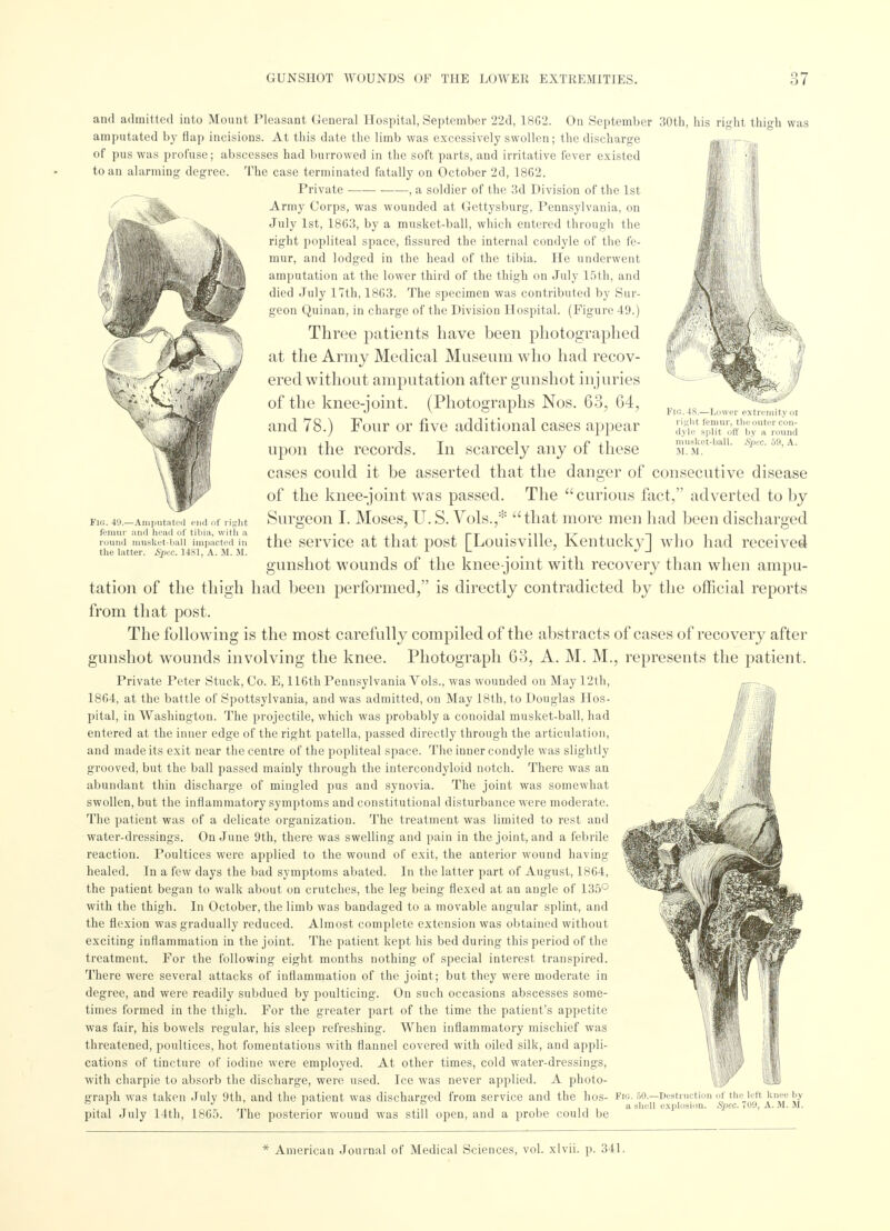 Fin. 4S.—Lower extremity 01 right femur, the outer con- dyle split off Ijy a round musket-ball. Spec 59, A. M. M. Fig. 49.—Amputated end of right femur and head of tibia, with a round musket-hall impacted in the latter. Spec. 1481, A. M. M. and admitted into Mount Pleasant General Hospital, September 22d, 18G2. On September 30th, his right thigh was amputated by flap incisions. At this date the limb was excessively swollen; the discharge of pus was profuse; abscesses had burrowed in the soft parts, and irritative fever existed to an alarming degree. The case terminated fatally on October 2d, 1862. Private , a soldier of the 3d Division of the 1st Army Corps, was wounded at Gettysburg, Pennsylvania, on July 1st, 1863, by a musket-ball, which entered through the right popliteal space, fissured the internal condyle of the fe- mur, and lodged in the head of the tibia. He underwent amputation at the lower third of the thigh on July 15th, and died July 17th, 1863. The specimen was contributed by Sur- geon Quinan, in charge of the Division Hospital. (Figure 49.) Three patients have been photographed at the Army Medical Museum who had recov- ered without amputation after gunshot injuries of the knee-joint. (Photographs Nos. 63, 64, and 78.) Four or five additional cases appear upon the records. In scarcely any of these cases could it be asserted that the danger of consecutive disease of the knee-joint was passed. The curious fact, adverted toby Surgeon I. Moses, U.S. Vols.,* that more men had been discharged the service at that post [Louisville, Kentucky] who had received gunshot wounds of the knee-joint with recovery than when ampu- tation of the thigh had been performed, is directly contradicted by the official reports from that post. The following is the most carefully compiled of the abstracts of cases of recovery after gunshot wounds involving the knee. Photograph 63, A. M. M., represents the patient. Private Peter Stuck, Co. E, 116th Pennsylvania Vols., was wounded on May 12th, 1864, at the battle of Spottsylvania, and was admitted, on May 18th, to Douglas Hos- pital, in Washington. The projectile, which was probably a conoidal musket-ball, had entered at the inner edge of the right patella, passed directly through the articulation, and made its exit near the centre of the popliteal space. The inner condyle was slightly grooved, but the ball passed mainly through the intercondyloid notch. There was an abundant thin discharge of mingled pus and synovia. The joint was somewhat swollen, but the inflammatory symptoms and constitutional disturbance were moderate. The patient was of a delicate organization. The treatment was limited to rest and water-dressings. On June 9th, there was swelling and pain in the joint, and a febrile reaction. Poultices were applied to the wound of exit, the anterior wound having healed. In a few days the bad symptoms abated. In the latter part of August, 1864, the patient began to walk about on crutches, the leg being flexed at an angle of 135° with the thigh. In October, the limb was bandaged to a movable angular splint, and the flexion was gradually reduced. Almost complete extension was obtained without exciting inflammation in the joint. The patient kept his bed during this period of the treatment. For the following eight months nothing of special interest transpired. There were several attacks of inflammation of the joint; but they were moderate in degree, and were readily subdued by poulticing. On such occasions abscesses some- times formed in the thigh. For the greater part of the time the patient's appetite was fair, his bowels regular, his sleep refreshing. When inflammatory mischief was threatened, poultices, hot fomentations with flannel covered with oiled silk, and appli- cations of tincture of iodine were employed. At other times, cold water-dressings, with charpie to absorb the discharge, were used. Ice was never applied. A photo- graph was taken July 9th, and the patient was discharged from service and the hos- pital July 14th, 1865. The posterior wound was still open, and a probe could be -Destruction of the left knee hy explosion. Spec. 709, A. M. M.