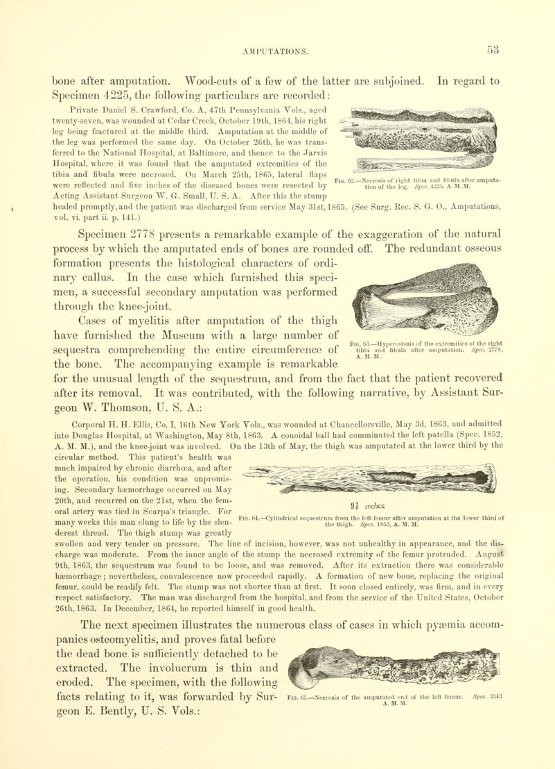 FlO. 02.—Necrosis of right tibia and fibula after amputa- tion of the leg. Spec. 422a, A. If. M. Fid. 63.—Hyperostosis of the extremities of the right tibia and fibula after amputation. Spec. 2778, A. M. M. bone after amputation. Wood-cuts of a few of the latter are subjoined. In regard to Specimen 4225, the following particulars are recorded: Private Daniel S. Crawford, Co. A, 47th Pennsylvania Vols., aged twenty-seven, was wounded at Cedar Creek, October 19th, 1864, his right leg being fractured at the middle third. Amputation at the middle of the leg was performed the same day. On October 26th, he was trans- ferred to the Natioual Hospital, at Baltimore, and thence to the Jarvis Hospital, where it was found that the amputated extremities of the tibia and fibula were necrosed. On March 25th, 1865, lateral flaps were reflected and five inches of the diseased bones were resected by Acting Assistant Surgeon W. G. Small, U. S. A. After this the stump healed promptly, and the patient was discharged from service May 31st, 1865. (See Surg. Rec. S. G. 0., Amputations, vol. vi. part ii. p. 141.) Specimen 2778 presents a remarkable example of the exaggeration of the natural process by which the amputated ends of bones are rounded off. The redundant osseous formation presents the histological characters of ordi- nary callus. In the case which furnished this speci- men, a successful secondary amputation was performed through the knee-joint. Cases of myelitis after amputation of the thigh have furnished the Museum with a large number of sequestra comprehending the entire circumference of the bone. The accompanying example is remarkable for the unusual length of the sequestrum, and from the fact that the patient recovered after its removal. It was contributed, with the following narrative, by Assistant Sur- geon W. Thomson, U. S. A.: Corporal H. H. Ellis, Co. I, 16th New York Vols., was wounded at Chancellorsville, May 3d, 1863, and admitted into Douglas Hospital, at Washington, May 8th, 1863. A conoidal ball had comminuted the left patella (Spec. 1852, A. M. M.), and the knee-joint was involved. On the 13th of May, the thigh was amputated at the lower third by the circular method. This patient's health was much impaired by chronic diarrhoea, and after l^S>^^^^S^^-^gg^^^^-r?-yr^g^!5g£?^^gL. A the operation, his condition was unpromis- ing. Secondary haemorrhage occurred on May 20th, and recurred on the 21st, when the fem- oral artery was tied in Scarpa's triangle. For many weeks this man clung to life by the slen- derest thread. The thigh stump was greatly swollen and very tender on pressure. The line of incision, however, was not unhealthy in appearance, and the dis- charge was moderate. From the inner angle of the stump the necrosed extremity of the femur protruded. August 9th, 1863, the sequestrum was found to be loose, and was removed. After its extraction there was considerable haemorrhage; nevertheless, convalescence now proceeded rapidly. A formation of new bone, replacing the original femur, could be readily felt. The stump was not shorter than at first. It soon closed entirely, was firm, and in every respect satisfactory. The man was discharged from the hospital, and from the service of the United States, October 26th, 1863. In December, 1864, he reported himself in good health. The next specimen illustrates the numerous class of cases in which pyaemia accom- panies osteomyelitis, and proves fatal before the dead bone is sufficiently detached to be extracted. The involucrum is thin and eroded. The specimen, with the following facts relating to it, was forwarded by Sur- geon E. Bently, U. S. Vols.: 91 inches Fio. 64.—Cylindrical sequestrum from the left femur after amputation at the lower third of the thigh. Spec. 1853, A. M. M. Fig. 65.—Necrosis of the amputated end of the left femur. A. M. M. Spec. 3343