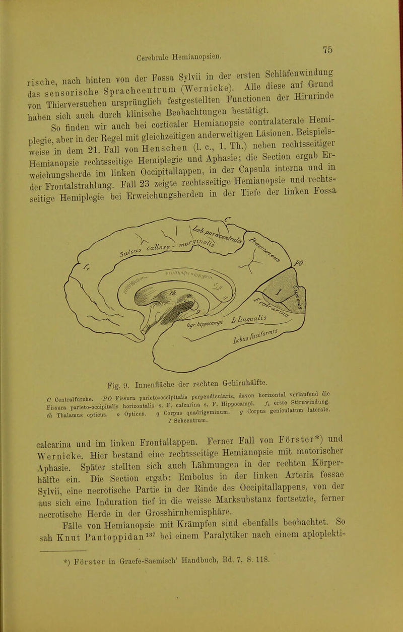 Hsche nach hinten von der Fossa Sylvii m der ersten Schlafenwrndung das seisorische Spvachcentrnm (Wernicke). Alle diese anf G und von ThieiTersuchen ursprünglich festgestellten Functionen der Hnm.nde l,nhpn sich auch durch klinische Beobachtungen bestätigt. So finden wir auch bei corticaler Hemianopsie contralaterale Hem - „i.,ie Iber in der Ke»el mit gleich-zeitigen anderweitigen Läsionen. Beispiels- Än de: sIeSi vonlenschen (I.e., 1-Th.) neben rechtsseitiger Hemianopsie rechtsseiüge Hemiplegie und Aphasie; die Section ergab Ei- wichungsherde im linken Occipitallappen, in der Capsula interna und m der Frontalstrahlung. Fall 23 zeigte rechtsseitige Hemianopsie und rechts- seÜige Hemiplegie bei Erweichungsherden in der Tiefe der linken Fossa Fig. 9. Innenfläche der recMen Gehirnhälfte. C Centraifurche. PO Pissura parieto-occipitalis perpendicularis, davon horizontal yerlaufena die Fisl: parieto-oecipitalis horizontalis s. F. calcarina s. F. Hippocampi. A ^^^^^^^^^^^ tu Thalamus opticus. o Opticus. , Corpus quadrigenünun.. g Corpus gemculatum laterale. J Sehcentrnm. calcarina und im linken Frontallappen. Ferner Fall von Förster*) und Wernicke. Hier bestand eine rechtsseitige Hemianopsie mit motorisclier Aphasie. Später stellten sich auch Lähmungen in der rechten Körper- hälfte ein. Die Section ergab: Embolus in der linken Arteria fossae Sylvii, eine necrotische Partie in der Einde des Occipitallappens, von der aus sich eine Induration tief in die weisse Marksubstanz fortsetzte, ferner necrotische Herde in der Grosshirnhemisphäre. Fälle von Hemianopsie mit Krämpfen sind ebenfalls beobachtet. So sah Knut Pantoppidan^»^ bei einem Paralytiker nach einem aploplekti- *) Förster in Graefe-Saeraisch' Handbuch, Bd. 7, S. 118.