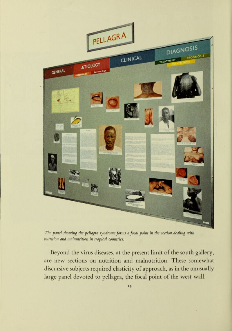 The panel showing the pellagra syndrome forms a focal point in the section dealing with nutrition and malnutrition in tropical countries. Beyond the virus diseases, at the present limit of the south gallery, are new sections on nutrition and malnutrition. These somewhat discursive subjects required elasticity of approach, as in the unusually large panel devoted to pellagra, the focal point of the west wall. H