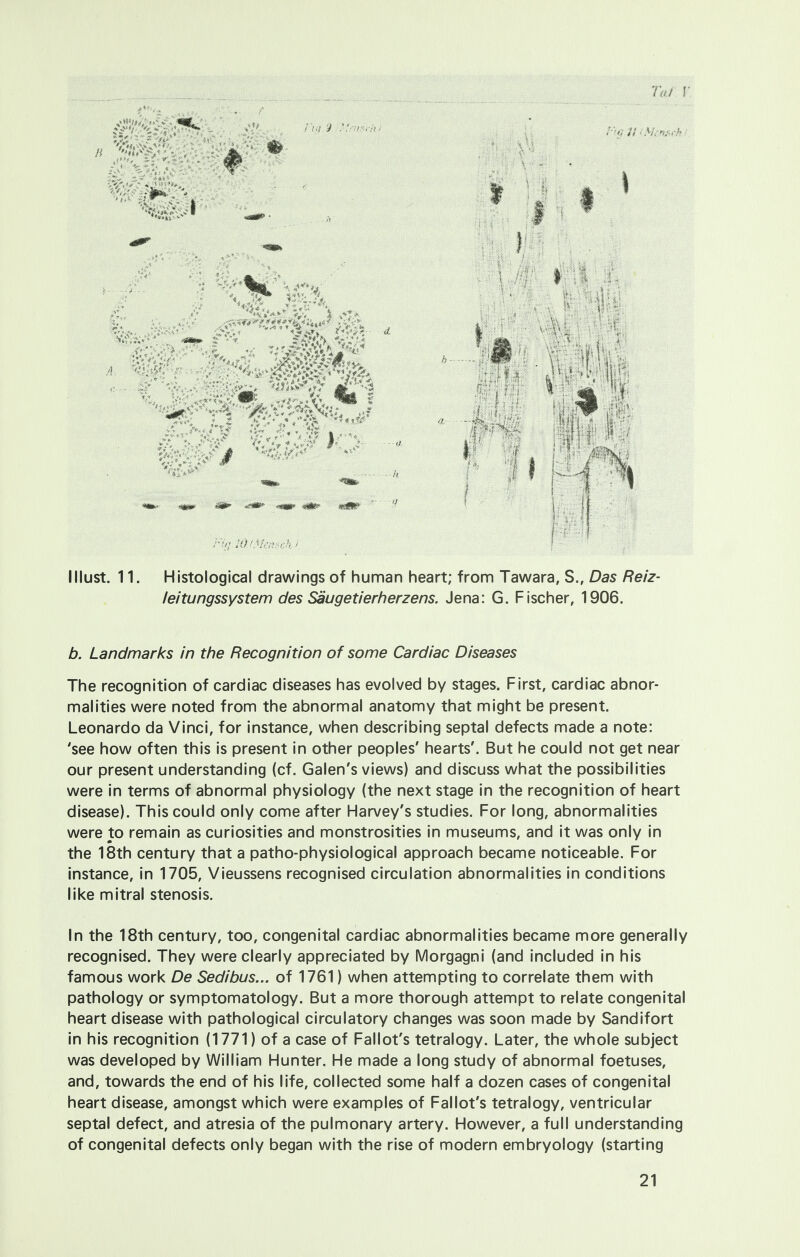 Ta t I lllust. 11. Histological drawings of human heart; from Tawara, S., Das Reiz- leitungssystem des Saugetierherzens. Jena: G. Fischer, 1906. b. Landmarks in the Recognition of some Cardiac Diseases The recognition of cardiac diseases has evolved by stages. First, cardiac abnor- malities were noted from the abnormal anatomy that might be present. Leonardo da Vinci, for instance, when describing septal defects made a note: 'see how often this is present in other peoples' hearts'. But he could not get near our present understanding (cf. Galen's views) and discuss what the possibilities were in terms of abnormal physiology (the next stage in the recognition of heart disease). This could only come after Harvey's studies. For long, abnormalities were to remain as curiosities and monstrosities in museums, and it was only in the 18th century that a patho-physiological approach became noticeable. For instance, in 1705, Vieussens recognised circulation abnormalities in conditions like mitral stenosis. In the 18th century, too, congenital cardiac abnormalities became more generally recognised. They were clearly appreciated by Morgagni (and included in his famous work De Sedibus... of 1761) when attempting to correlate them with pathology or symptomatology. But a more thorough attempt to relate congenital heart disease with pathological circulatory changes was soon made by Sandifort in his recognition (1771) of a case of Fallot's tetralogy. Later, the whole subject was developed by William Hunter. He made a long study of abnormal foetuses, and, towards the end of his life, collected some half a dozen cases of congenital heart disease, amongst which were examples of Fallot's tetralogy, ventricular septal defect, and atresia of the pulmonary artery. However, a full understanding of congenital defects only began with the rise of modern embryology (starting