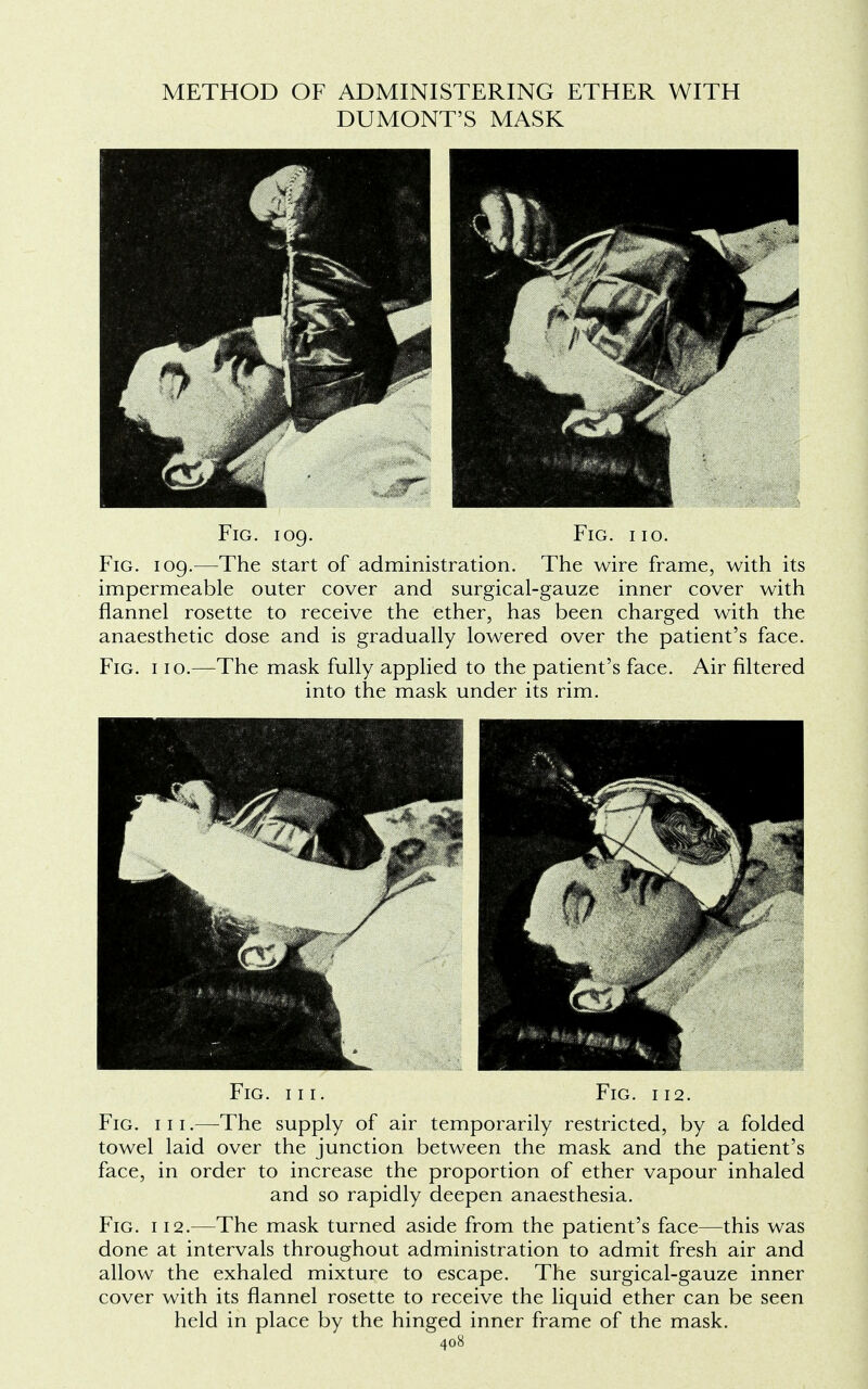 METHOD OF ADMINISTERING ETHER WITH DUMONT'S MASK Fig. 109. Fig. iio. Fig. 109.—The start of administration. The wire frame, with its impermeable outer cover and surgical-gauze inner cover with flannel rosette to receive the ether, has been charged with the anaesthetic dose and is gradually lowered over the patient's face. Fig. 110.—The mask fully applied to the patient's face. Air filtered into the mask under its rim. Fig. hi. Fig. 112. Fig. 111.—The supply of air temporarily restricted, by a folded towel laid over the junction between the mask and the patient's face, in order to increase the proportion of ether vapour inhaled and so rapidly deepen anaesthesia. Fig. 112.—The mask turned aside from the patient's face—this was done at intervals throughout administration to admit fresh air and allow the exhaled mixture to escape. The surgical-gauze inner cover with its flannel rosette to receive the liquid ether can be seen held in place by the hinged inner frame of the mask.