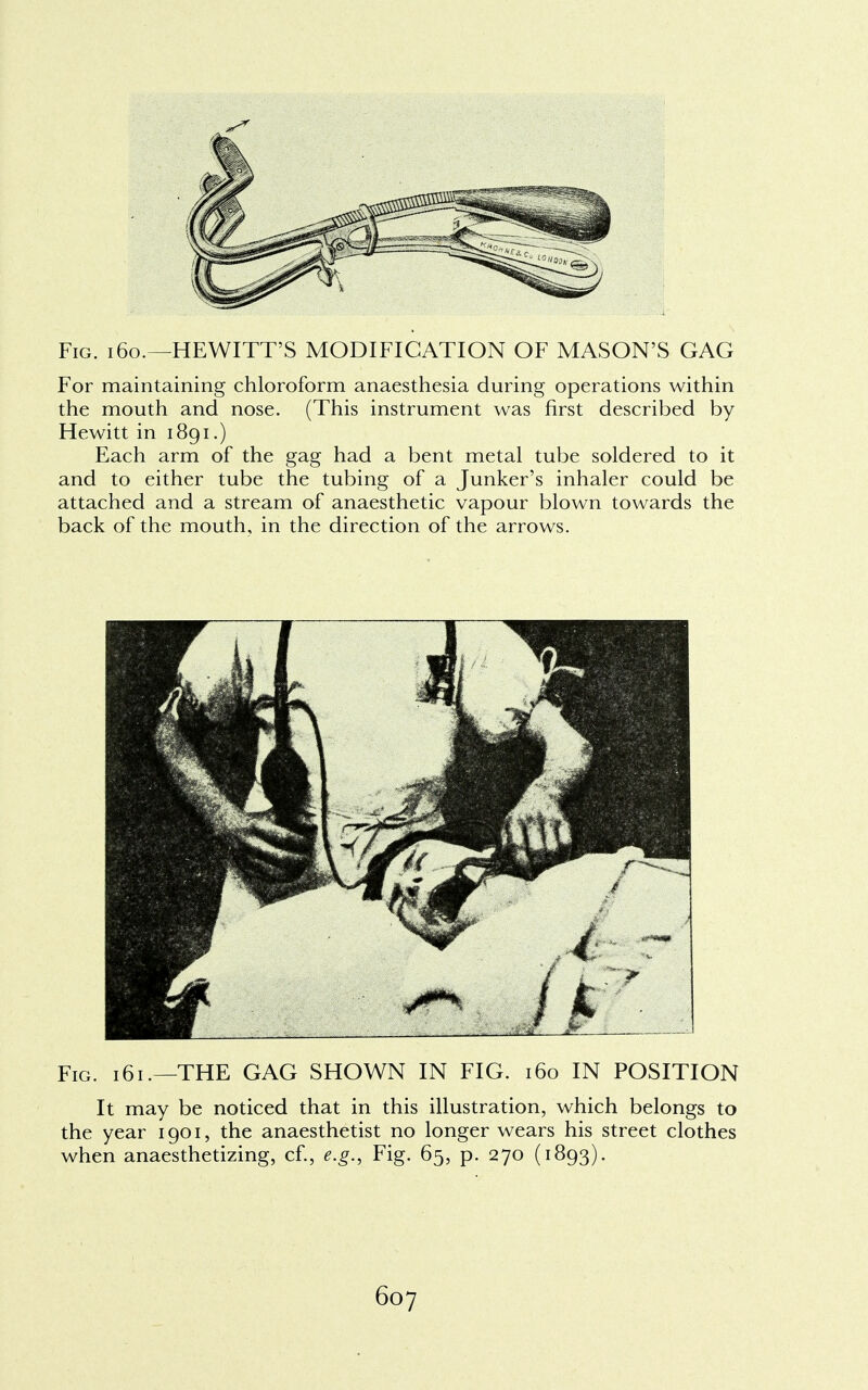 Fig. i60.—HEWITT'S MODIFICATION OF MASON'S GAG For maintaining chloroform anaesthesia during operations within the mouth and nose. (This instrument was first described by Hewitt in 1891.) Each arm of the gag had a bent metal tube soldered to it and to either tube the tubing of a Junker's inhaler could be attached and a stream of anaesthetic vapour blown towards the back of the mouth, in the direction of the arrows. Fig. 161.—THE GAG SHOWN IN FIG. 160 IN POSITION It may be noticed that in this illustration, which belongs to the year 1901, the anaesthetist no longer wears his street clothes when anaesthetizing, cf., e.g., Fig. 65, p. 270 (1893).