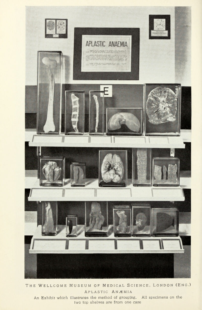 The Wellcome Museum of Medical Science, London (Eng.) Aplastic Anemia An Exhibit which illustrates the method of grouping. All specimens on the two top shelves are from one case