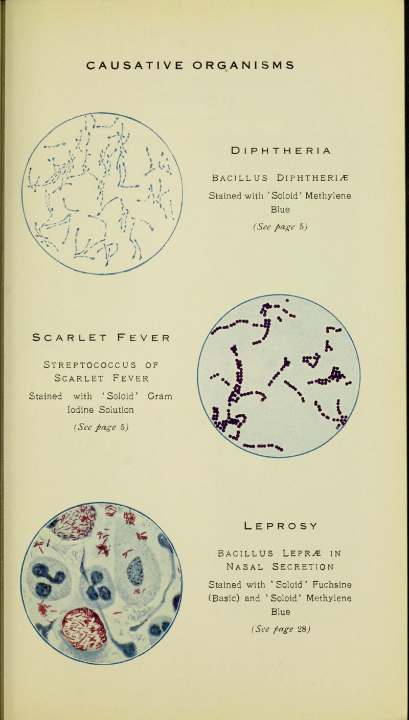 CAUSATIVE ORGANISMS Scarlet Fever Streptococcus of Scarlet Fever Stained with ' Soloid' Gram Iodine Solution (See page b) Diphtheria Bacillus Diphtheria Stained with 'Soloid' Methylene Blue (See Page 5) Leprosy bacillus lepra in Nasal Secretion Stained with k Soloid ' Fuchsine (Basic) and 'Soloid' Methylene Blue (See page 28 j