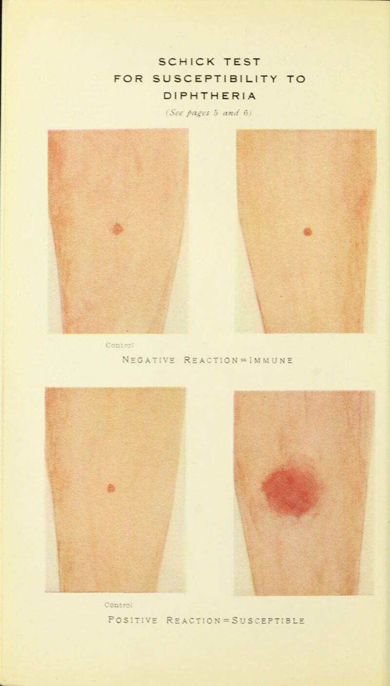 SCHICK TEST FOR SUSCEPTIBILITY TO DIPHTHERIA (See j>cigfs 5 and 6 Control Negative Reaction = Immune Control