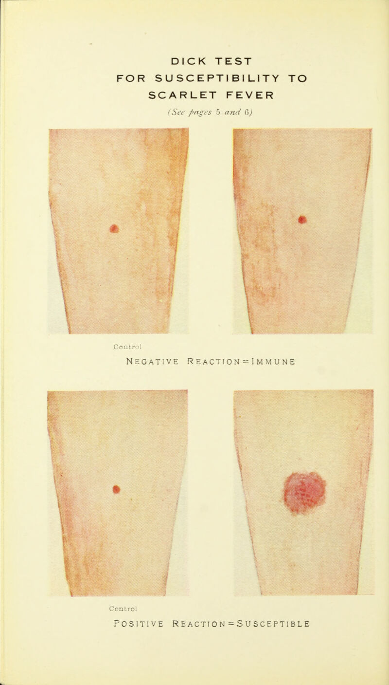 DICK TEST FOR SUSCEPTIBILITY TO SCARLET FEVER (See pages 5 and Q>) Control Negative Reaction--Immune Control Positive Reaction ^Susceptible