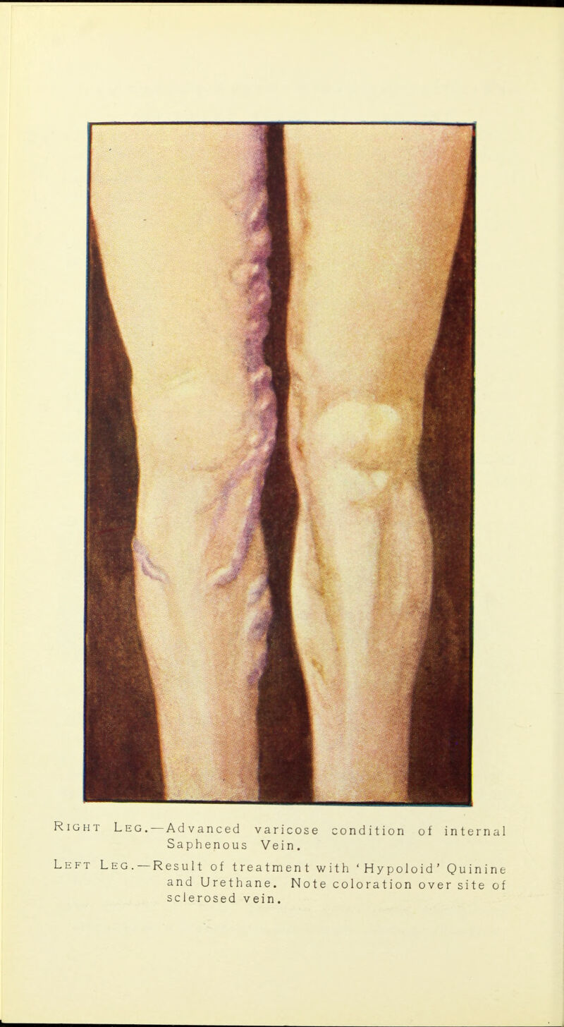 Right Leg. —Ad vanced varicose condition of internal Saphenous Vein. Left Leg. —Result of treatment with 'Hypoloid' Quinine and Urethane. Note coloration over site of sclerosed vein.