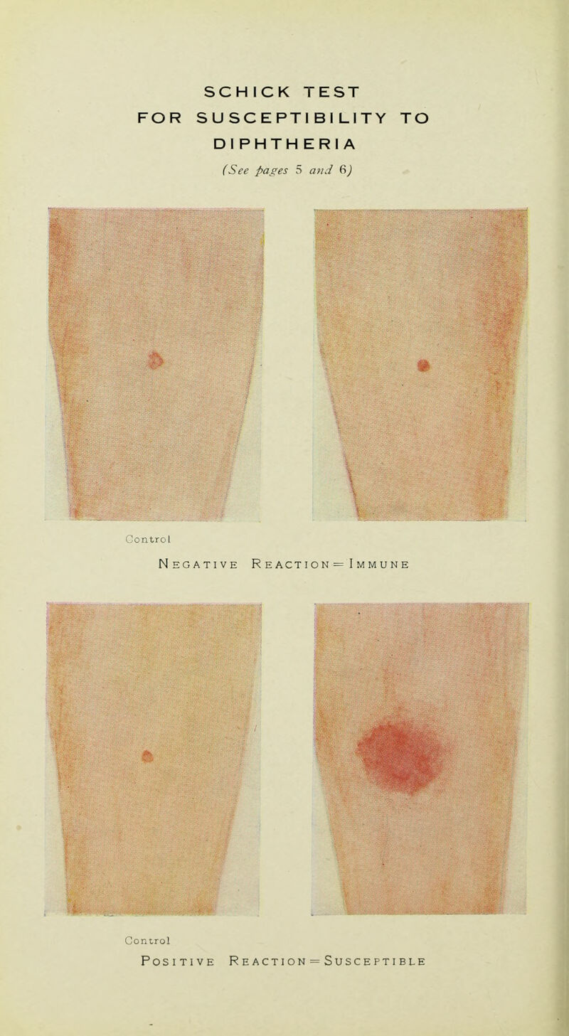 SCHICK TEST FOR SUSCEPTIBILITY TO DIPHTHERIA (See pages 5 and 6) Negative R eaction = I mmune Control Positive Reaction = Susceptible