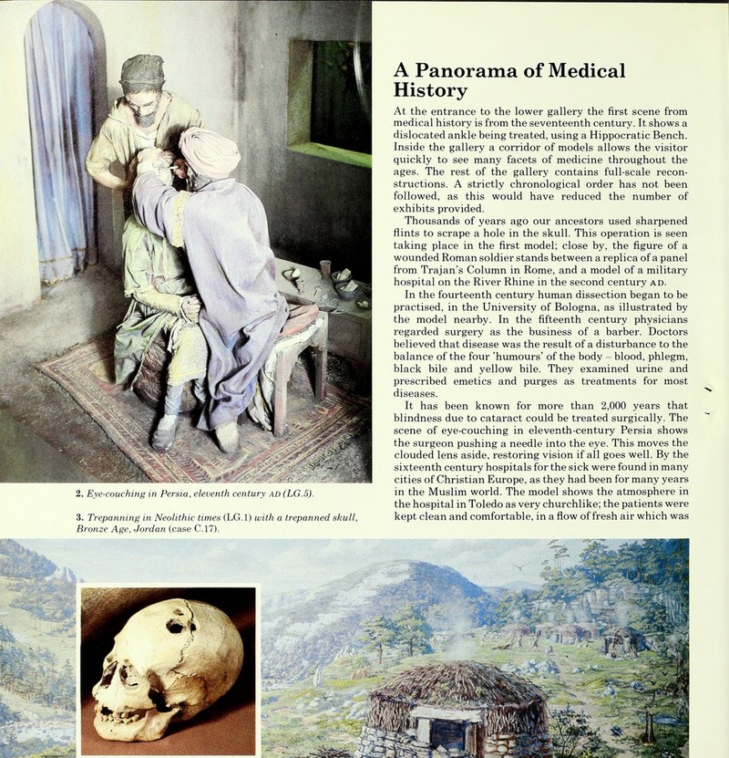 3. Trepanning in Neolithic times (LG.l) with a trepanned skull, Bronze Age, Jordan (case C.17). A Panorama of Medical History At the entrance to the lower gallery the first scene from medical history is from the seventeenth century. It shows a dislocated ankle being treated, using a Hippocratic Bench. Inside the gallery a corridor of models allows the visitor quickly to see many facets of medicine throughout the ages. The rest of the gallery contains full-scale recon- structions. A strictly chronological order has not been followed, as this would have reduced the number of exhibits provided. Thousands of years ago our ancestors used sharpened flints to scrape a hole in the skull. This operation is seen taking place in the first model; close by, the figure of a wounded Roman soldier stands between a replica of a panel from Trajan's Column in Rome, and a model of a military hospital on the River Rhine in the second century ad. In the fourteenth century human dissection began to be practised, in the University of Bologna, as illustrated by the model nearby. In the fifteenth century physicians regarded surgery as the business of a barber. Doctors believed that disease was the result of a disturbance to the balance of the four 'humours' of the body - blood, phlegm, black bile and yellow bile. They examined urine and prescribed emetics and purges as treatments for most diseases. It has been known for more than 2,000 years that blindness due to cataract could be treated surgically. The scene of eye-couching in eleventh-century Persia shows the surgeon pushing a needle into the eye. This moves the clouded lens aside, restoring vision if all goes well. By the sixteenth century hospitals for the sick were found in many cities of Christian Europe, as they had been for many years the hospital in Toledo as very churchlike; the patients were kept clean and comfortable, in a flow of fresh air which was