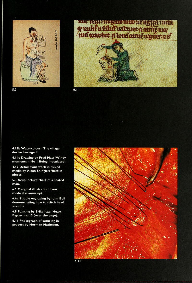 mm 4.13b Watercolour: 'The village doctor besieged'. 4.14c Drawing by Fred May: 'Windy moments - No 1 Being inoculated'. 4.17 Detail from work in mixed media by Aidan Shingler: 'Rest in pieces'. 5.3 Acupuncture chart of a seated man. 6.1 Marginal illustration from medical manuscript. 6.6a Stipple engraving by John Bell demonstrating how to stitch head wounds. 6.8 Painting by Erika Itta: 'Heart Bypass' no. 15 (over the page). 6.11 Photograph of suturing in process by Norman Matheson. ^^^^ 6.11