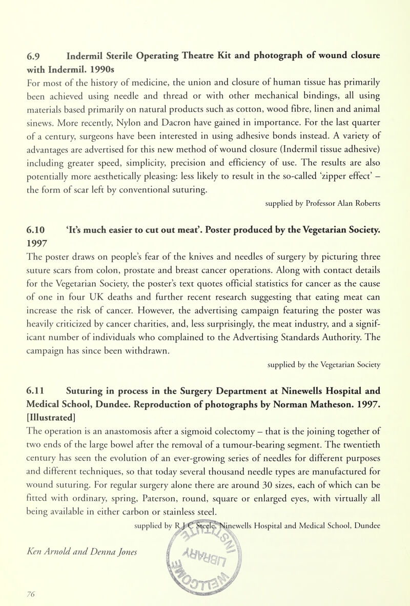 6.9 Indermil Sterile Operating Theatre Kit and photograph of wound closure with Indermil. 1990s For most of the history of medicine, the union and closure of human tissue has primarily been achieved using needle and thread or with other mechanical bindings, all using materials based primarily on natural products such as cotton, wood fibre, linen and animal sinews. More recently, Nylon and Dacron have gained in importance. For the last quarter of a century, surgeons have been interested in using adhesive bonds instead. A variety of advantages are advertised for this new method of wound closure (Indermil tissue adhesive) including greater speed, simplicity, precision and efficiency of use. The results are also potentially more aesthetically pleasing: less likely to result in the so-called 'zipper effect' - the form of scar left by conventional suturing. supplied by Professor Alan Roberts 6.10 'It's much easier to cut out meat'. Poster produced by the Vegetarian Society. 1997 The poster draws on people's fear of the knives and needles of surgery by picturing three suture scars from colon, prostate and breast cancer operations. Along with contact details for the Vegetarian Society, the poster's text quotes official statistics for cancer as the cause of one in four UK deaths and further recent research suggesting that eating meat can increase the risk of cancer. However, the advertising campaign featuring the poster was heavily criticized by cancer charities, and, less surprisingly, the meat industry, and a signif- icant number of individuals who complained to the Advertising Standards Authority. The campaign has since been withdrawn. supplied by the Vegetarian Society 6.11 Suturing in process in the Surgery Department at Ninewells Hospital and Medical School, Dundee. Reproduction of photographs by Norman Matheson. 1997. [Illustrated] The operation is an anastomosis after a sigmoid colectomy - that is the joining together of two ends of the large bowel after the removal of a tumour-bearing segment. The twentieth century has seen the evolution of an ever-growing series of needles for different purposes and different techniques, so that today several thousand needle types are manufactured for wound suturing. For regular surgery alone there are around 30 sizes, each of which can be fitted with ordinary, spring, Paterson, round, square or enlarged eyes, with virtually all being available in either carbon or stainless steel. supplied by RJ G SteeleTNinewells Hospital and Medical School, Dundee Ken Arnold and Denna Jones i AM\fLt