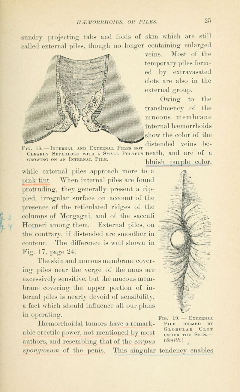 sundry projecting tabs and folds of skin which are still called external ])iles, though no longer containing enlarged veins. Most of the temporary piles form- ed by extravasated clots are also in the external group. Owing to the translucency of the mucous membrane internal hasmorrhoids ^^show the color of the „ distended veins be- FiG. 18. — Internal and Exteknal Piles not Cleakly Separable with a Small Polypus neatll, and are ot a GROWING ON AN INTERNAL PiLE. blui&h ^ pUlJ)le COlor, \ while external piles approach more to a pink tint. When internal piles are found protruding, they generally present a rip- pled, irregular surface on account of the presence of the reticulated ridges of the columns of Morgagni, and of the sacculi Horneri among them. External piles, on the contrary, if distended are smoother in contour. The difference is well shown in Fig. 17, page 24; The skin and mucous membrane cover- ing piles near the verge of the anus are excessively sensitive, but the mucous mem- brane covering the upper portion of in- ternal piles is nearly devoid of sensibility, a fact which should influence all our plans in operating. HtBmorrhoidal tumors have a remark- able erectile power, not mentioned by most authors, and resembling that of the corpus spongiosum of the penis. This singular tendency enables Fig. 19. — External Pile formed by Globular Clot under the Skin.— {Smith.)