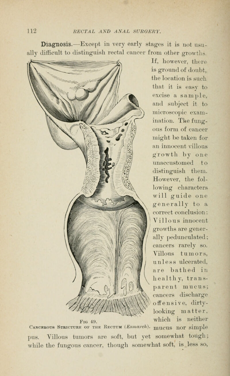 Diagnosis.—Except in veiT early stages it is not usu- ally difficult to distinguish rectal cancer from other growths. If, hoAvever, tliere is ground of doubt, the location is such that it is easy to excise a sample, and subject it to microscopic exam- ination. The fung- ous form of cancer might be taken for an innocent A'illous growth by one unaccustomed t o distinguish them. However, the fol- lowing characters will guide one generally to a correct conclusion: ' Villous innocent / growths are gener- ally pedunculated; cancers rarely so. Villous t u m o r s, unless ulcerated, are bathed in healthy, trans- parent mucus; cancers discharge offensive, dirty- looking matter, Pje 49 which is neither Canobbotjb STBiCTtJBE OF THE Rectum (Esmcirch). mucus nor .simple pus. Villous tumors are soft, but yet somewhat tough; while the fungous cancer, though somewhat soft, is less so,