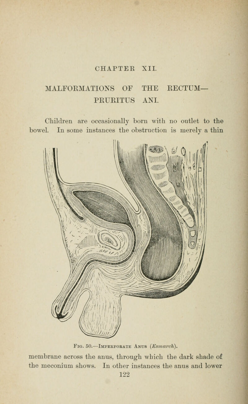 MALFORMATIONS OF THE EECTUM- PEUEITUS ANI. Childi'en are occasionally born with no outlet to the bowel. In some instances the obstruction is merely a thin Fig. 50.—Impeefobate Anus (Esmarch). membrane across the anus, through which the dark shade of the meconium shows. In other instances the anus and lower