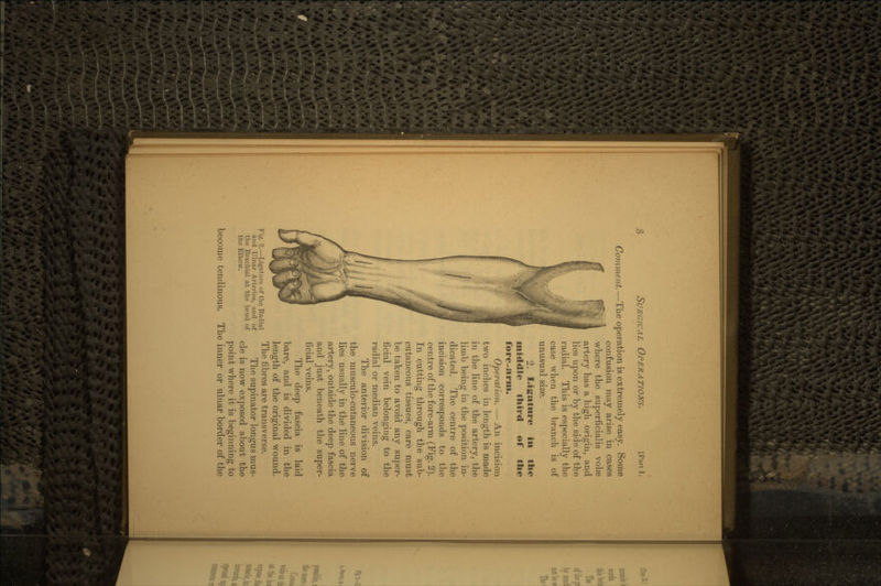 SURGICAL OPERATIONS. [Part I. Comment.—The operation is extremely easy. Some confusion may arise in cases where the superficialis volse artery has a high origin, and lies upon or by the side of the radial. This is especially the case when the branch is of unusual size. 2. Ligature * the middle third of the fore-arm. Operation. — An incision two inches in length is made in the line of the artery, the limb being in the position in- dicated. The centre of the incision corresponds to the centre of the fore-arm (Fig. 2). In cutting through the sub- cutaneous tissues, care must be taken to avoid any super- ficial vein belonging to the radial or median veins. The anterior division of the musculo-cutaneous nerve lies usually in the line of the artery, outside the deep fascia and just beneath the super- ficial veins. The deep fascia is laid bare, and is divided in the length of the original wound. The fibres are transverse. The supinator longus mus- cle is now exposed about the point where it is beginning to The inner or ulnar border of the Fig. 2.—Ligature of the Radial and Ulnar Arteries, and of the Brachial at the bend of the Elbow. become tendinous.