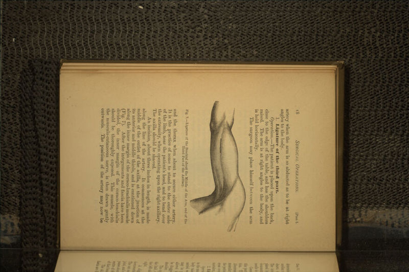 artery when the arm is so abducted as to be at right angles to the body. 1. Ligature of the third part. Operation.—The patient is placed upon the back, close to the edge of the table, and has the shoulders raised. The arm is at right angles to the body, and is held horizontally. The surgeon may place himself between the arm Fig. 7.—Ligature cf the Braohial about the Middle of the Arm, and of the Third Part of the Axillary. and the thorax when about to secure either artery. It is the practice of some to stand to the outer side of the limb, near the patient's head, and to bend over the extremity, when operating upon the right axillary. The axilla should be shaved. An incision, about three inches in length, is made along the line of the artery. It commences at the middle of the outlet of the axilla, at the junction of its anterior and middle thirds, and is continued down along the inner margin of the coraco-brachialis muscle (Fig. 7). After the integuments and fascia have been divided, the inner margin of the coraco-brachialis should be thoroughly exposed. This muscle, with the nmseulo-cutaneous nerve, is then drawn gently outwards. The position of the artery may now be
