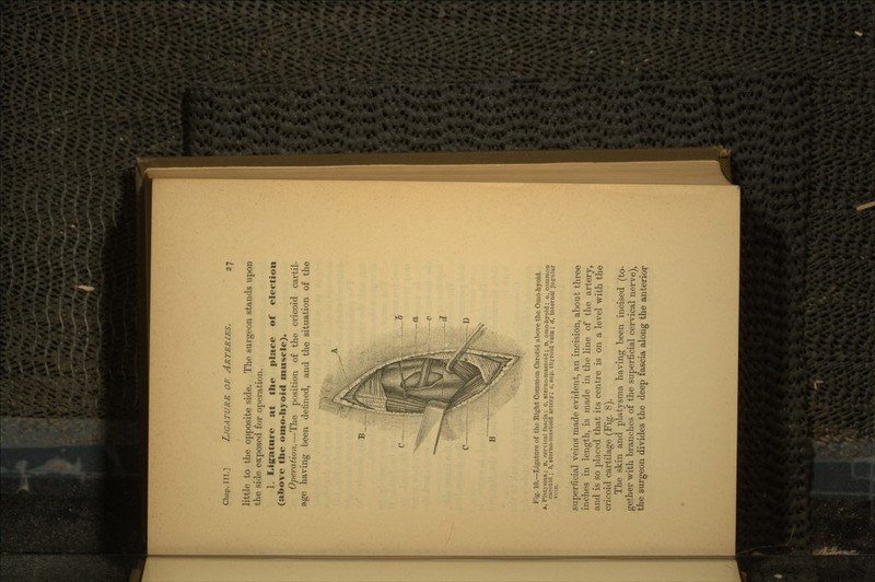 little to the opposite side. The surgeon stands upon the side exposed for operation. 1. Ligature at the place of election (above the oino-hyoicl muscle). Operation.—The position of the cricoid cartil- age having been denned, and the situation of the Fig. 10. — Ligature of the Right Common Carotid above the Omo-hyoid. A, Platysina; u, cervical fascia; o, sterno-mastoid ; D, qmo-hyoid ; a, common carotid; b, sterno-niastoid artery ; c, sup. thyroid vein ; d, internal jugular superficial veins made evident, an incision, about three inches in length, is made in the line of the artery, and is so placed that its centre is on a level with the cricoid cartilage (Fig. 8). The skin and platysma having been incised (to- gether with branches of the superficial cervical nerve), the surgeon divides the deep fascia along the anterior