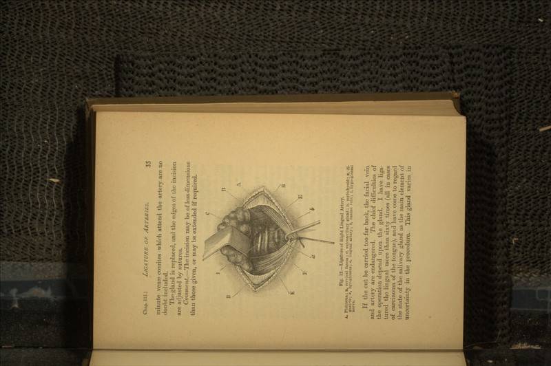 minute venre comites which attend the artery are no doubt included. The gland is replaced, and the edges of the incision are adjusted by sutures. Comment.—The incision may be of less dimensions than those given, or may be extended if required. •* Fig. 12.—Ligature of Right Lingual Artery. A, Platysma; B, cervical fascia; c, subinaxillary gland; D, inylo-hyoid; w, di- gastric; F, hyo-glossus; a, lingual artery; b, ranine veiu; 1, hypo-glossal nerve. If the cut be carried too far back, the facial vein and artery are endangered. The chief difficulties of the operation depend upon the gland. I have liga- tured the lingual more than sixty times (all in cases of carcinoma of the tongue), and have come to regard the state of the salivary gland as the main element of uncertainty in the procedure. This gland varies in