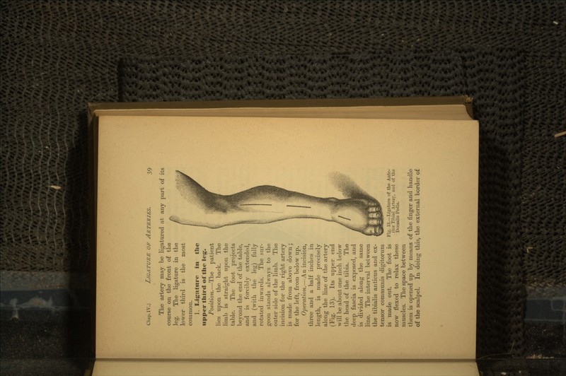 The artery may be ligatured at any part of its course on the front of the leg. The ligature in the lower third is the most common. 1. Ligature in the upper third of the leg*. Position.—The patient lies upon the back. The limb is straight upon the table. The foot projects beyond the end of the table, and is forcibly extended, and (with the leg) fully rotated inwards. The sur- geon stands always to the outer side of the limb. The incision for the right artery is made from above down; for the left, from below up. Operation.—An incision, three and a half inches in length, is made precisely along the line of the artery (Fig. 13). Its upper end will be about one inch below the head of the tibia. The deep fascia is exposed, and is divided along the same line. The interval between the tibialis anticus and ex- tensor communis digitorum is made out. The foot is now flexed to relax these muscles. The space between them is opened up by means of the finger and handle of the scalpel. In doing this, the external border of Fig. 13.-Ligature of the Ante- rior Tibial Artery, ami of the Dorsalis Pedis.