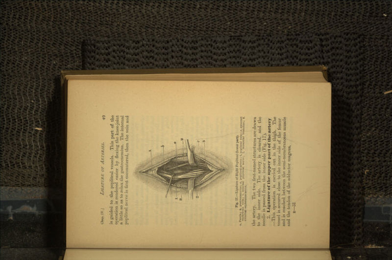 is guided to the popliteal vessels. This part of the operation is rendered easier by flexing the knee-joint a little so as to relax the gastrocnemius. The internal popliteal nerve is first encountered, then the vein and Fig. 17.—Ligature of Bight Popliteal (lower part). A, Fascia; B, gastrocnemius; a, popliteal artery; b, popliteal vein: c, external saphenous vein; 1, internal popliteal nerve; L', muscular branches; 3, external saphenous nerve. the artery. The two first-named structures are drawn to the inner side. The artery is cleared, and the needle is passed from the inner side (Fig. 17). 2. Ligature of tlie upper part of the artery —This operation is carried out in the thigh. The vessel is secured close to the inner side of the femur and is reached between the semi-membranosus muscle/ and the tendon of the adductor niagnus. E—31