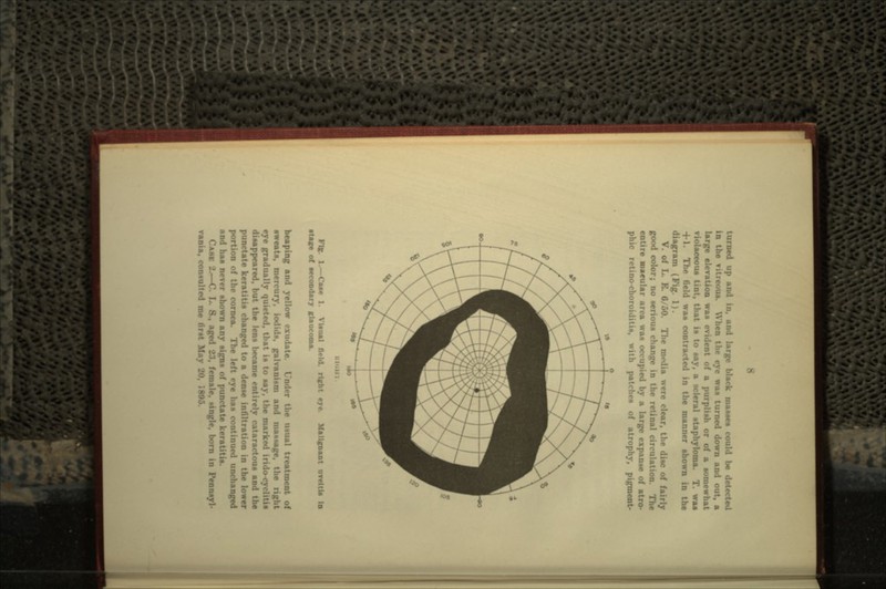 turned up and in. and large black masses could be detected in the vitieuua. NYhcn the eye waa turned down and out, a large elevation waa evident of a purplish or of a somewhat violaceous tint, that is to say, a acleral sUphyloma. T. waa 4-1. The field wa» contracted in the manner shown in the diagram (Pig. V. of L. R. 6/60. Hie mfdia were clear, the disc of fairly good color; no serious change in the retinal circulation uiaeular area was occupied by a large expanse of atro phic retinochoroiditia, with patches of atrophy, pigment- Malignant areltls la heaping and yellow exudate. In.l.-r the usual treatment of sweats, mercury, iodidn, galvanism and massage, the eye gradually quieted, that is to say. the marked irido < diMpprarH. hut the lens became entirely cataractous an<l the punctate keratitis changed to a dense mtiltrn- lower portion of the cornea. The left eye has continued unchanged and has never shown any signs of punctate kerati* CAM 2.—C. L. a, aged 23. female, single. I nnsyl- vania. consulted me rirst May 20, 2805.