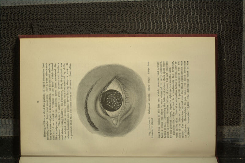 measles, scarlet fever and smallpox. For a year afterwards her eye* were subject to inflammation. At 12 she had malaria, and at 10 an attack of redness in the face which looked • las. She has suffered much from menstrual dis- family history is good, parents and brother* being healthy. In IVhniary, 1804, the patient waa the subject of an illness, which was characterized by chills, intense headache and general fever lasting about a week. It is probable that thu \vas some form of influenza. Soon after- Fl». 2.—Case 2 Msllsji Inecnlarlj placed. ly sts««. Lars* dots ward r , of the left eye. which, however, had always been a weak eye sine* it was ulcerated in early childhood, began to fail. Preceding the failure of vision, black spots were much in evidence. Similar failure of vision, but not preceded by any general illness, began in right eye ten months later. JftwmiiMifto*.—The patient is a moderately tall bn neral examination failed to reveal any le- rnal organs. A pelvic examination waa not made ne was normal and the blood examination waa as foil. : li «5 per cent; red blood corpuscles UK); leucocyUs 10,400. The differential count of the