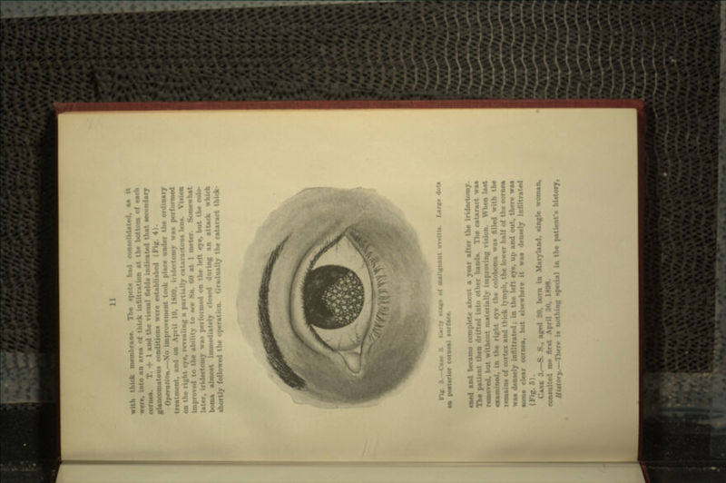 ncmbrane. The spots had consolidated, aa it were, into an area <>t bottom of each cornea. T. + 1 and the visual fields indicated that secondary glaucomatous conditions were established (Pig. 4). Operation.—No improvement took place under the ordinary nont, and on April 10, 1890. hideetomy was performed right eye, revealing a partially cataractous lens. Vision improved to the ability to »ee Sn. GO at 1 meter. Somewhat later, iridectomy wu* pci formed on the left eye, but the colo- boma almost i y closed during an attack which shortly followed the operation. Gradually the cataract thick Fig. 3.—Case 3 Karlj .t on posterior cornea! surface. aveltls. Large dots ened and became complete about a year after the iridectomy. The patietr it ted Into other hands. The cataract was I, but without materially improving vision. When last sd. i e the coloboma was filled with the remains of cortex ami thick lymph, the lou.-r half of the cornea waa densely infiltrated; in the left eye, up and out, there was some clear cornea, but elsewhere it waa densely infiltrated (Fig. 5). CABS 3.—S. S., aged 20, born in Maryland, single woman, consulted mo ri, H«8. tory.—There is nothing special in the patient's history,