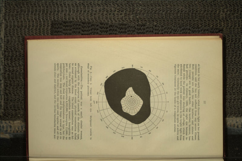 ind the has n -u any severe illness. Both parent* are well, two older brothers and sisters and two younger are in good health. One brother, however, has had phlhiftih. In .January, 1808, the right eye became in flamed while the patient was studying at college, which was ilc and exposure to the I the snow. Gradually the eye got worse, in spite of active and vigorous treatment at the hands of a competent oculist. Flf. 4.—Case 2. Visual field, l. of secondary glaucoma. Malignant uvcltis In .—The patient was a small, slender woman, <>n of anetnfa « : type, Mood count, physical examine to reveal organic disease. The blood exa was as fol- lows: Color fairly good; coajr tmal; hemoglobin 05 per cent.; red blood corpuscles 4,282,000; leucocyte* 11,000; no poikilocytoais. The chest was emphywmat i m t\ |..-. but the respiration wan in all re- spects. The cai ii wan rapid and regular and all the sounds clear nn : laries were nor-