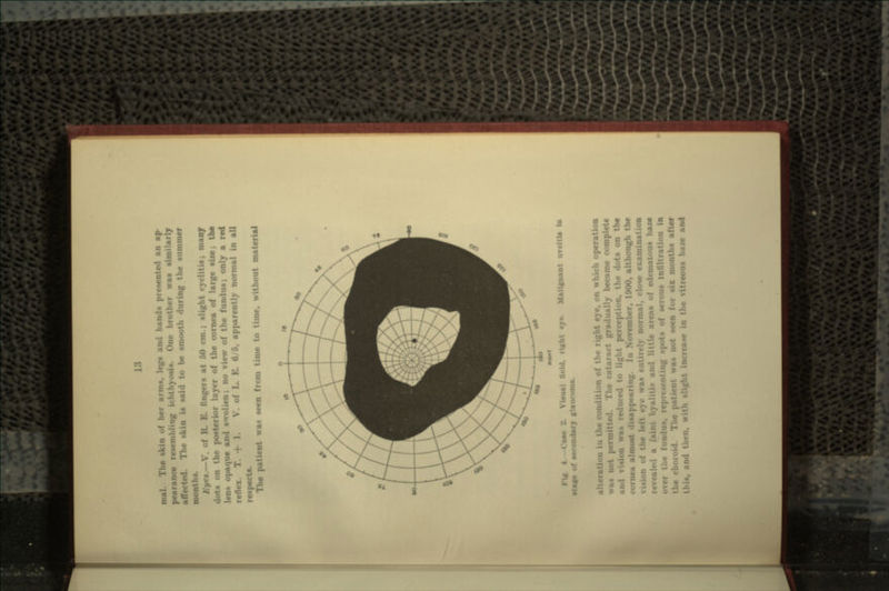 The -km of her arm*, leg* and hand* presented an ap- pearui !>yoeis. One brother waa similarly t>e amooih during the Hummer Kyc».—\'. of R. E. fingers at 50 cm.; alight cyclitis; many dot* on the posterior layer of the cornea of large size; the leoa opaque and swollen; no view of the fundue; only a red l \ I I 6/5, apparently normal in all i* seen from time to time, without material «'aae 2. Visual Held, rlicht cjre. of »*i-unilarj glaucoma. Mnllgunnt areltia la alter.. of the right eye, on which operation waa not j- atarnct gradually became complete .••ts on the cornea almost disappearing. In November, 1900, although the normal, clow examination revealed a areas of edematoua ban -pots of serous infiltration in the choioid. The patient was not seen for aix months after i.i-i- in the vitreous haze and