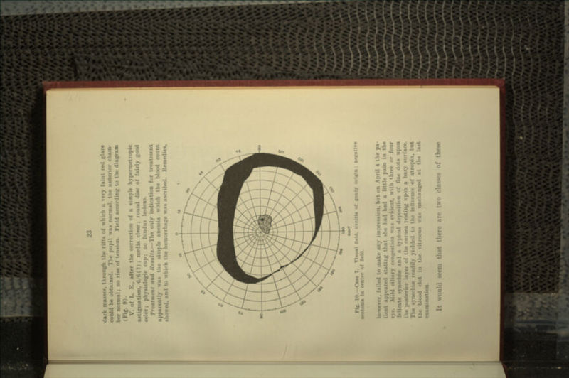 dark masse*, through the rifts of wt faint red glare be obtained. The pupil was normal, the anterior cham- ber normal; no riae of ten- ! according to the diagram 9). V. of L. E., after the correction of a simple hypermetropie astigmatism, fl/6(T) ; media clear; round disc of fairly good color; physiologic cup; no fundus lesions. Treatment and Ktsutt*.—The only indication for treatment apparently wan n>»- simple anemia which the blood •howr : hi. li the hemorrhage was ascribed. flf. 10.—Case 7. VUual field, uveltls of »outy origin : Dtffatlre seotoma In center of flsKL however, failed to make any impression, I 4 the pa .ippeared stating that she had had a little pain in the iy congestion was c\ -h three or four delicate synechi* and a typical deposition of fine dots upon the posterior layer of the cornea resting upon a hazy surface. The ftvnechir i. to the influence of atropin, but the blood clot in tin- vitreous was unchanged at the last .voultl seem that there are two classes of these