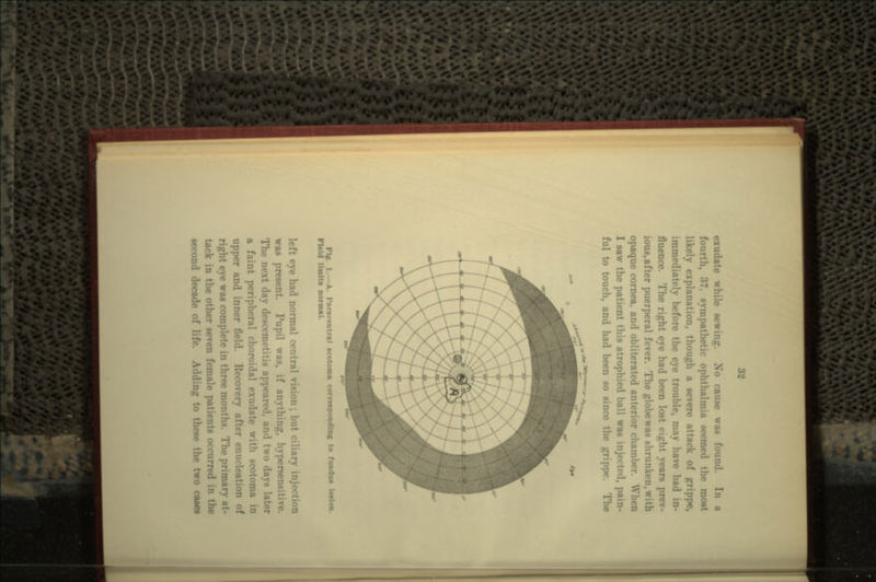 exudatc while sewing. No cause was found. fourt rnpathetic ophthalmia seemed the most likely explanation, though a severe attack of grippe, immediately before the eye trouble, may have had in- fluence. The right eye had been lost eight yean prev- ious,after puerperal fever. The globewas shrunken opaque cornea, and obliterated anterior chamber. When I saw the patient this atrophied ball was injected, pain- ful to touch, and had been so since the grippe. Ptff. I-—A. rmrarontral BcotooA corresponding to fundui talon. Fltld I Halts normal. left eye had normal central vision; but ciliary inj was present. Pupil was, if anything, hypersensitive. The next day descemetitis appear**!, and two days later a faint peripheral choroidal exudate with scotoma in upper and inner field. Recovery after enucleation of eye was complete in three months. The primn tack in the other seven female patients occurred in the second decade of life. Adding to these the two