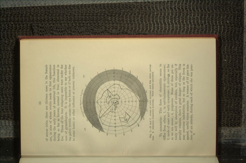 of serous iritis, there arc thirteen cases in the female n nine of whom uveitis made its first appearance •ig the early years of menstrual life, this function being, so far as known, normal in four, abnormal in five. Three of the four relapsing cases were under the care of gynecologists. It is impossible to say whether the }>• hie causes the eye lesion or if both are due to some hemic or other influence at present unknown. Flf. 2.--H and C. Art*a of color •cotoma and dim white Hon. 8. Absolute transient •cotoma. Field Unit* narrowed To summarize: This form of choroiditis seems to 1. in ophthalmoscopic appearances; / onset and rarly symptoms; 3, etiology, so far as we are aware; 4, prognosis. Some of them get en- ' by absorption of exudate, but, especially if atrophy remains, there is great danger of relapse. This may com finitely, but so long as the fovea is span i. A woman of 42 pave his- acks, during each of which she was prar-