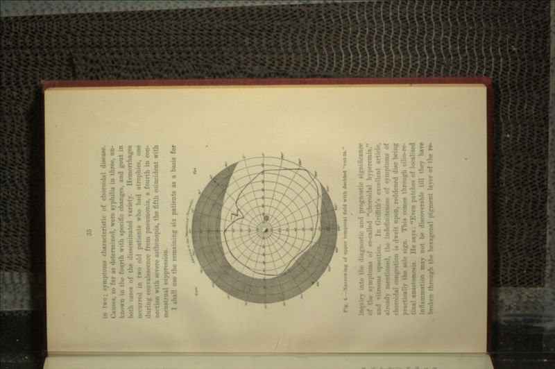 »ms characteristic of choroidal disease. Causes, so far as determined, were syphilis in three, un- known in th with specific changes, and gout in both cases of the disseminated variety. Hemorrhages occurred in two old patients who had atrophies, one during convalescence from pneumonia, a fourth in con- •n with severe asthenopia, the fifth coincident with ! suppression. I shall use the remaining six patients as a basis for Fl». 4 —Narrowing of upper temporal field with derided or agnostic and prognostic significance mptoms of so-called choroidal hyperci <>us opaciii.•*. IT teness of symptoms of choroidal congestion is dwelt upon, reddened disc being sole sign. This comes through ci! tinal anastomosis. He says Batches of localised inflammation may not be discoverable till they have broken through the hexagonal pipment layer of the re-
