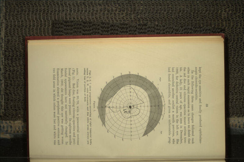 kept the eye sensitive and finally produced ophthalmo- ecopic choroido In tii.- following three cases changes followed each other in such rapid succession as to leave no doubt that the red disc and vitreous opacities meant serious trou- ble. A lady, 31 years of age, waa seen in December, 1900, for defective central vision in the left eye. She had consulted another oculist a month previous, who had found choroiditK and <jiv<'ii nn unfavorable prog- ,• Figure 7. Flffs. 6, 6. 7 show profcrcMlre narrowing of right temporal field i letters Y, X. w. color scotomata and dim white areas always pre- UlillH Ion of portion of field. nosis. Vision was 20/70, with a paracentral so (Fig. 1). Red disc, floating vitreous opacities and foveal pigment heaps were prose i fundal appearances have not materially changed -he thought this eye was getting worse. Examination showed a peripheral positive scotoma and two field areas \\\ »rs were lost and white was