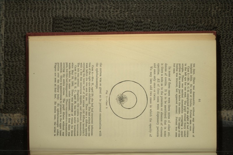 ten days. There was deaceinetitis without any evidence of incipir; note of fundu*. Patient teen once. CASK 3.—Mr. M. C. O. complained of the light of bad vUion in the left eye for one week. The pupil dilated freely under atropia. There waa marked deacemetitia occupying a small portion of the cornea just below the center. The image of the fundua waa blurred, but appeared normal. Patient waa eeen but In none of these cases were there notes of other evi- dences of uveitis. It is to be mentioned that in none is there a note as to the presence or absence of vitreous opacities. All of these cases were dispensary patients and seen only once or twice. We may here add two cases in which the opacity of rig. i the cornea was so great as to prevent examination with the ophthalmoscope. CASE 4.—Mrs. H., aged 29; she had had recurrent inflamma- tion of the right eye ainee childhood. The laat attack began one week before the waa teen by me. There waa a diffuae opacity covering the lower half of the cornea (old diffuse kerat with a few fine calcareous depoaiU, and distinct descent The iris was normal. Diagnosis: Old ureitis with recurrence. CASE 5.—Mr. R. K. C., aged 38, baa ben under treatment since May 20, 1002. There waa dimneas of vision for three weeks before he came under treatment. At first there waa pain, but this had disappeared. There waa extensive deacemetiUs covering the entire cornea. The pupil dilates without any •ynechist. There is snmlllmisei to pressure in the upper inner portion over the ciliary body. No ophthalmoecopic reflex, re teen at four feet. He denies lues; the urine is