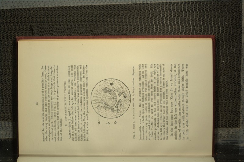 normal. In this C»M the descemetitis is of a peculiar form. Be- sides the many coarae and fine opacities usually seen, there deposit* arranged somewhat in the form of a circle around part. These deposits are very large and irregular See Fig. '2 probable that there is .H. but the opacity at present prevent* examina- of the fundus. B. DB80BMBTITI8 WI1 118. CAB* 6.—Mrs. B., aged 31, was seen Dec. 22, 1807, complain ing of a mist before the left eye for several days. The pupil ad maximum under a mydriatic; the vitreous was r, the fundus normal, but there was extensive descemetitis. iodid of potash the condition gradually improved, and following May the cornea was almost clear. In Septenv r, 1808. a few small permanent opacities resulting from the Fig. 2.—Case 5. a. Strlate keratltls; b, large conOuent deposits. descemetitis were found. But in October she returned with descemetitis in both eyes and distinct synechi*. At no time was there any pain. Iodid of potash was again ordered and atropia used and the condition rapidly improved. CASK 7.—Mr. C.. sged 40, was seen June 10, 1000. Six '« previously he had had severe iritis in the right eye and an iridectomy had been done. He now complains of pain in the left . o are no synechi*. but a coarse descemeti- tis covers the lower half of the cornea. There is no note of the fundus and the patient was not seen again. In the last case but one (Case 6) we found desce- i the left eye without other evidence, at the is: ten months later there was recurrence in both eyes with distinct though slight iritis. There is little doubt but that the chief trouble here was