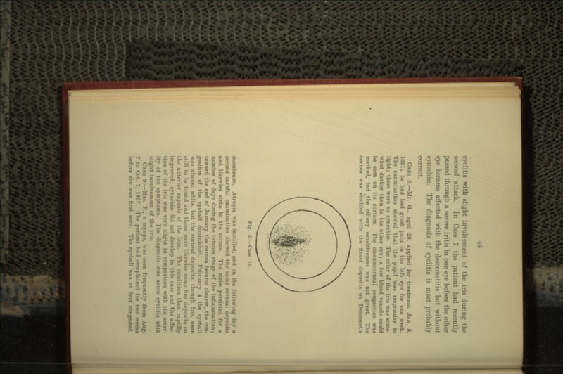 -.a with slight involvement of the iris during the second attack. In Case 7 the patient had recently passed through a severe iritis in one eye before the other eye became affected with the descemetitis but without synechia?. The diagnosis of cyclitU is most probably correct. CASE 8.—Mr. G., aged 28, applied for treatment Jan. 8, 1801; he had had great pain in the left eye for one week. The examination showed that the pupil was responsive to light; there were no synechuv. The color of the iris waa some- what darker than in the other eye; a few blood veaaels could be teen on its surface. The circumcorneal congestion was marked, but the ciliary sensitiveness waa not great. The cornea waa atudded with the finest deposits on Desccroet's Ptf. 8.—Case 10. Atropta was instilled, and on the following day a second careful examination showed the same corneal deposits and likewise atria) in the cornea. The stris? persisted for a number of days during the intense stage of the inflammation; toward the end of January the cornea became clearer, the con Station of the eyeball <1. ruary 4 the eyeball waa almost white, but the corneal deposits, though fine, were Mill to be found and there were likewise some fine deposits on the anterior capsule of the lens. The condition then rapidly improved; synechis? did not develop in this case and the affec- tion of the iris waa very omparison with the sever- ity of the symptoms. The diagnosis waa acute cyclitis with -light involvement of the iris. CA«E 9.—-Mrs. P., a myope, was seen frequently from Aug. 7 to Oct. 7. 1807. The patient had complained for two weeks before she was first seen. The eyeball was at first