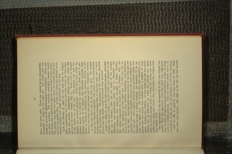 Torre was little pain. There waa typical gross deecemetitis, i.ipe in thr n-ht «•-.. The media were too lalmoecopic examination. There was one small aynechia. The condition gradually became clearer nally but a few brown deposits were found on the cornea. The patient waa seen two years later, the fundus found nor- mal and the media clear. In this case there was without unubi intern*. - nt of the iris. CASK 10.—George H., aged 25, waa seen early in August, 1806, complaining that his eye hud been cloudy for four days. There was peculiar descemetitis, almost circular, which did ich the lower limbus (Fig. 3). There were no changes I he patient waa aeen (re 1 carefully examined, \\lien after four weeks the had cleared up (leaving a little spot of per- il opacity in its center), fine dust-like opacities were in enormous quantities in the anterior portion of the vitreous, and there was one larger opacity. Diagnosis: eyclitis. In this case there was at no time any pain. The eyeball became but slightly congested. The extent of the desceroetitis became somewhat enlarged after it waa first seen, but it never lost the round shape. The presence of the vitreous opacities proves that the deeper uveal structures were involved. CASE 11.—Miss F.. aged 30, with excessive myopia, choroidal atrophy and poor vision (—15 Da. oYUO), was operated on the left eye in October, 1000, for the relief of the myopia. Disci t»ion waa performed twice and in December the lens substance was removed through a linear incision, vision improved so much that in October, 1001, ahe came for operation on the right eye. In this eye the re- moral .car lens, without iridectomy, waa performed .!, 1001. Barring alight incarceration of the iris, and one •ynechia, there was excellent recovery, but some cortical mat- ! his mpi<lly absorbed and excellent vision was obtained through a central opening. On December 11 the pa- ws* again seen. The eyeball had been somewhat con- gested and the coinea waa »tudded with a number of large spots. Atropia was ordered. In two weeks the eye was much clearer an. mary 14. whet: ient was again seen, no fundus chsnge could be found, the cornea and other media were clear, and vision after correcting the astigmatism waa almost 6 : appearance of the drscemetitia in this case almost two wont I e operation, when the pupil was sufficiently <• allow of ophthalmoscopic exn makes the diag- no«i» Nnibt due to in- carceration presence of old iritic synechi*. CAME 12 vas seen June 24. 1803. Both *«re The sight of the left eye had