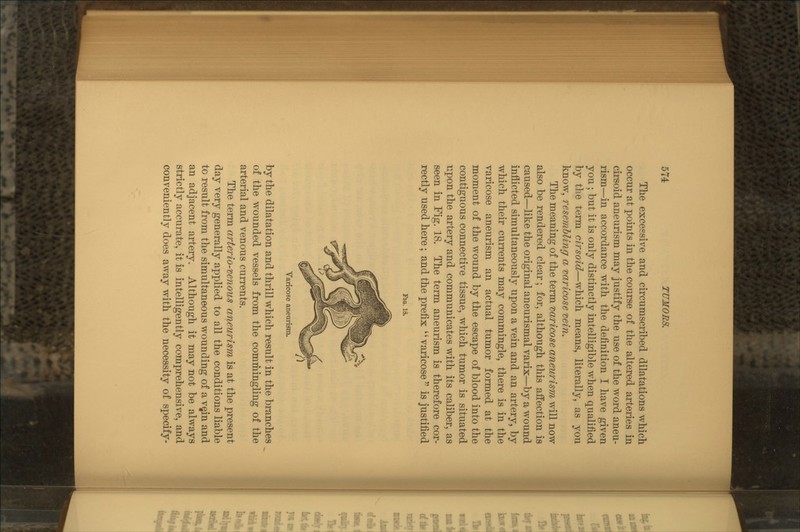 The excessive and circumscribed dilatations which occur at points in the course of the altered arteries in cirsoid aneurism may justify the use of the word aneu- rism—in accordance with the definition I have given you ; but it is only distinctly intelligible when qualified by the term cirsoid—which means, literally, as you know, resembling a varicose vein. The meaning of the term varicose aneurism will now also be rendered clear; for, although this affection is caused—like the original aneurismal varix—by a wound inflicted simultaneously upon a vein and an artery, by which their currents may commingle, there is in the varicose aneurism an actual tumor formed at the moment of the wound by the escape of blood into the contiguous connective tissue, which tumor is situated iipon the artery and communicates with its caliber, as seen in Fig. 18. The term aneurism is therefore cor- rectly used here; and the prefix varicose is justified FIG. 18. Varicose aneurism. by the dilatation and thrill which result in the branches of the wounded vessels from the commingling of the arterial and venous currents. The term arterio-venous aneurism is at the present day very generally applied to all the conditions liable to result from the simultaneous wounding of a ve,in and an adjacent artery. Although it may not be always strictly accurate, it is intelligently comprehensive, and conveniently does away with the necessity of specify-