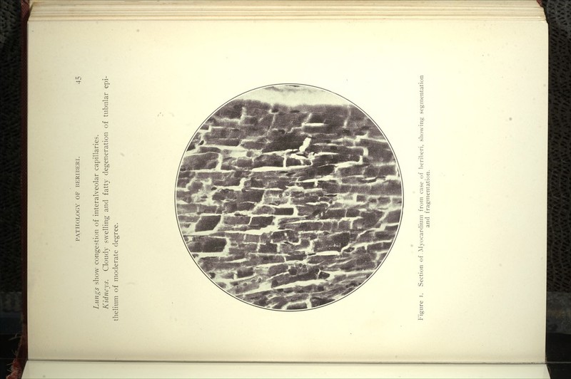 Lungs show congestion of interalveolar capillaries. Kidneys. Cloudy swelling and fatty degeneration of tubular epi- thelium of moderate degree. P'igure I. Section of AJyocardinm from case of l^eriberi, showing segmentation and fragmentation.