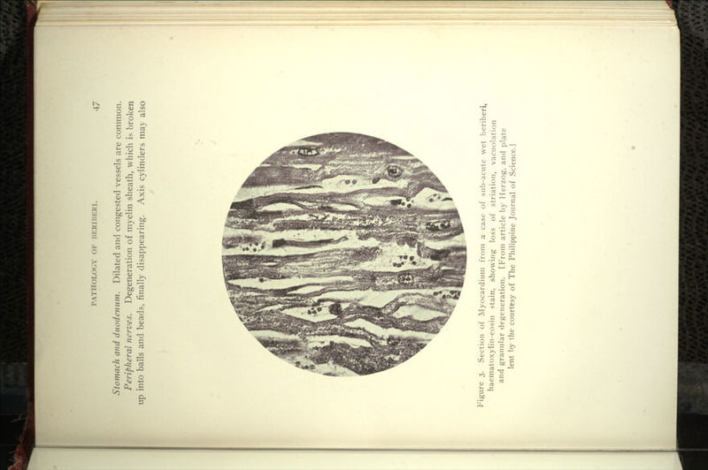 Stomach and duodenum. Dilated and congested vessels are common. Peripheral nerves. Degeneration of myelin sheath, which is broken up into balls and beads, finally disappearing. Axis cylinders may also Figure 3. Section of Myocardium from a case of sub-acute wet beriberi, haematoxylin-eosin stain, showing loss of striation, vacuolation and granular degeneration. [From article by Herzog, and plate lent by the courtesy of The Philippine Journal of Science.]