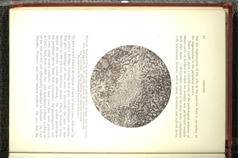 that the degeneration of the cells in the anterior horn is secondary to the degeneration in the peripheral nerves. Diirck (1908) made a careful study of the pathological anatomy of eleven cases of beriberi in which the autopsy was performed immedi- ately after death. Unfortunately several of his cases were complicated with intercurrent diseases, such as sprue, dysentery and typhoid fever. Figure 6. Section of liver from a case of acute beriberi, showing fatty degenera- tion and necrosis in the central area of the lobule. Haematoxylin and Eosin stain. [From Herzog, and plate lent through the courtesy of the Philippine Journal of Science.] He gave a brief clinical description of each of these cases, followed by the autopsy findings, including both gross and microscopic anatomy. The gross pathology of these cases is practically the same as that described by the previous observers quoted. Diirck, however, inves- tigated the nervous system quite minutely. He studied particularly the peripheral nerves from both extremities, the pneumogastric, and the cord, using several methods. In some cases they were preserved in Orth's fluid, from which they were transferred without washing to 70 per cent alcohol and subsequently embedded in celloidin. He used Marchi's, Weigert's and other modern methods. He says that the