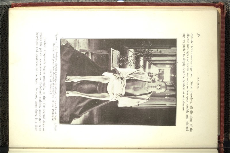 consider both diseases together. Since, therefore, all divisions of the disease into types or forms are more or less questionable and mislead- ing, we prefer to simply describe beriberi as one disease. Figure 7. Dr\- hcriliori, showing acU'anced atrophy of nmsclcs ol' legs. [I^'roii llerzog. ard plate lent through the conrtes\- of tlie Philippine Journal of Science. I Beriberi frecjuently begins gradually, so that for several days or weeks the ])atient experiences an ill-defined malaise, associated with In some cases there is a little heaviness and weakness of the legs