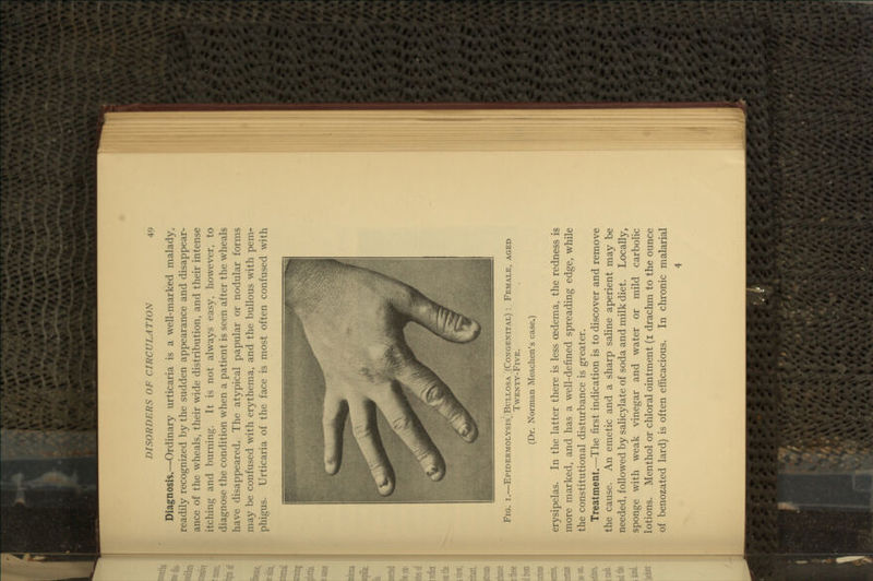 Diagnosis.—Ordinary urticaria is a well-marked malady, readily recognized by the sudden appearance and disappear- ice of the wheals, their wide distribution, and their intense tching and burning. It is not always easy, however, to liagnose the condition when a patient is seen after the wheals lave disappeared. The atypical papular or nodular forms lay be confused with erythema, and the bullous with pem- )higus. Urticaria of the face is most often confused with Fig. I.—Epidermolysis] Bullosa ^Congenital) Twenty-Five. (Dr. Norman Meachen's case.) Female, aged erysipelas. In the latter there is less oedema, the redness is lore marked, and has a well-defined spreading edge, while [the constitutional disturbance is greater. Treatment.—^The first indication is to discover and remove Lthe cause. An emetic and a sharp saline aperient may be leeded, followed by salicylate of soda and milk diet. Locally, sponge with weak vinegar and water or mild carboHc lotions. Menthol or chloral ointment (i drachm to the ounce of benozated lard) is often efficacious. In chronic malarial 4